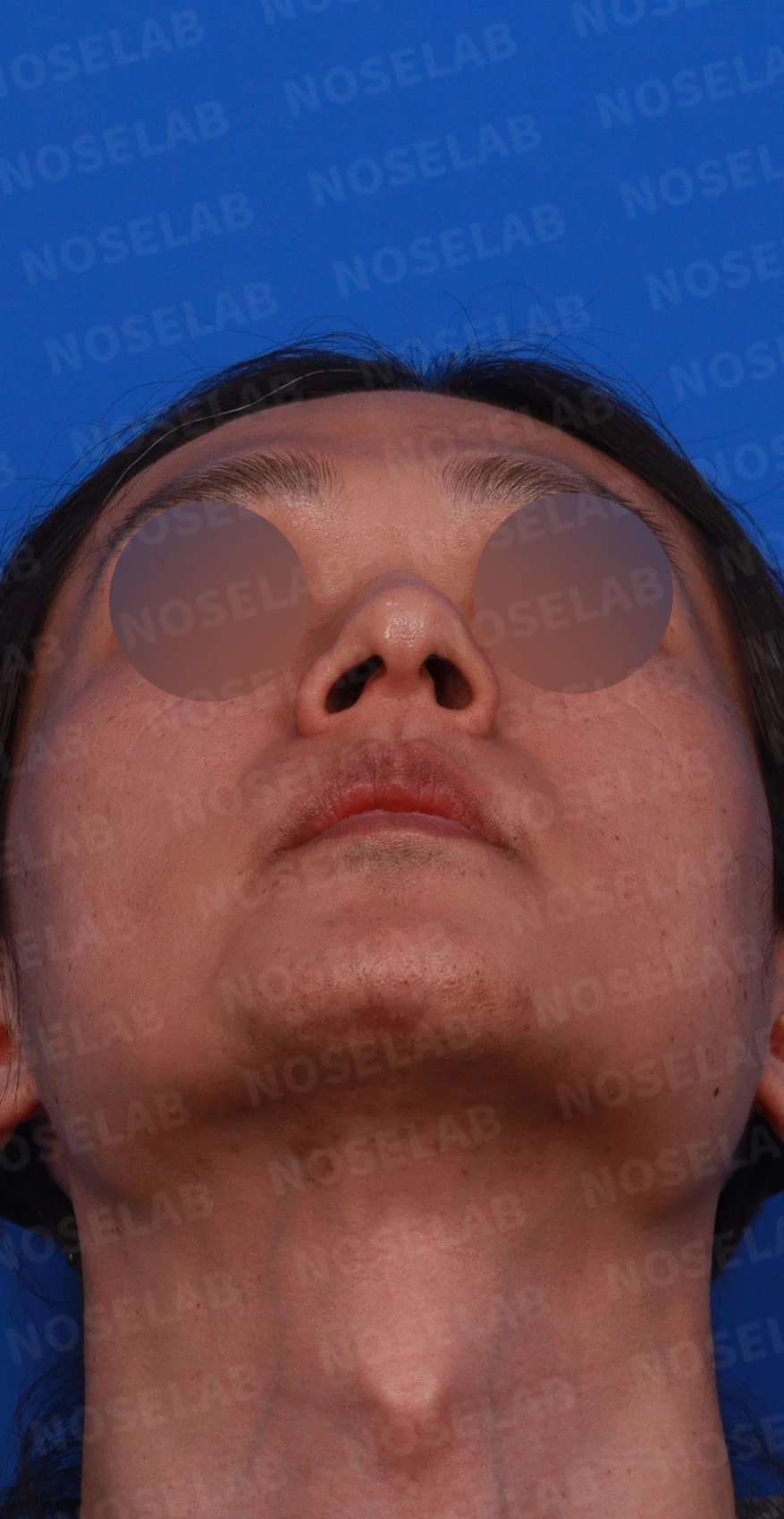 안면 비대칭이 있는 코에 맞춤형 보형물을 쓰는 이유와 매부리 교정 방법 — 디자인 상담 우측 측면,비스듬한 측면, 비공 사진입니다.