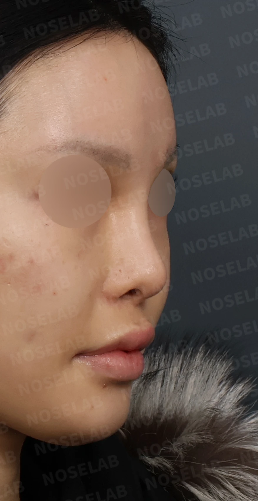 심한 비중격 만곡과 높은 콧대 시작점, 기증늑연골로 정밀 재건 — 디자인 상담 우측 측면, 비스듬한 측면, 비공 사진입니다.