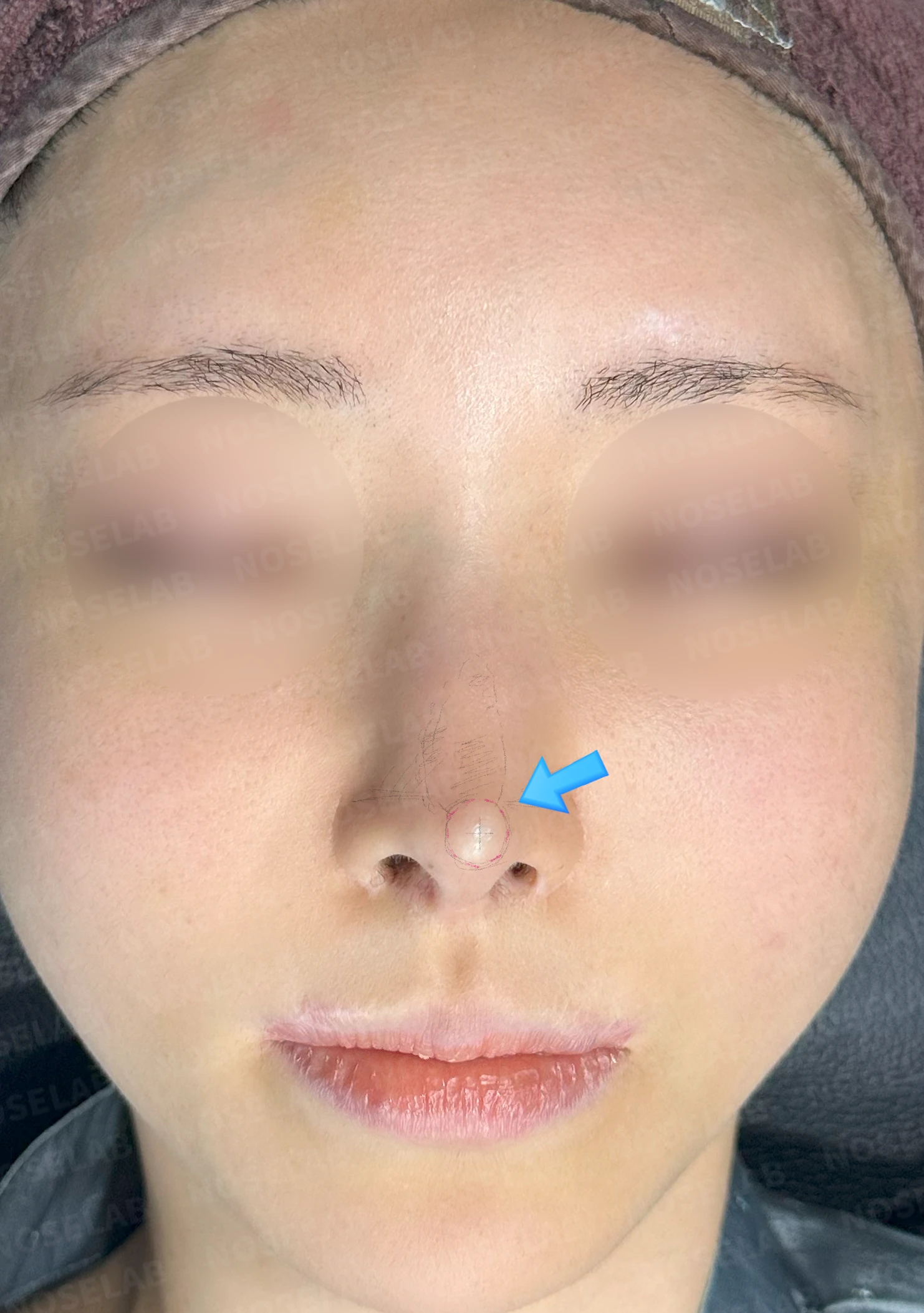 뾰족한 코끝과 연골 비침의 교정 방법 — 전(좌) 정면 사진, 전(우) 코끝 연골 비춤(화살표)