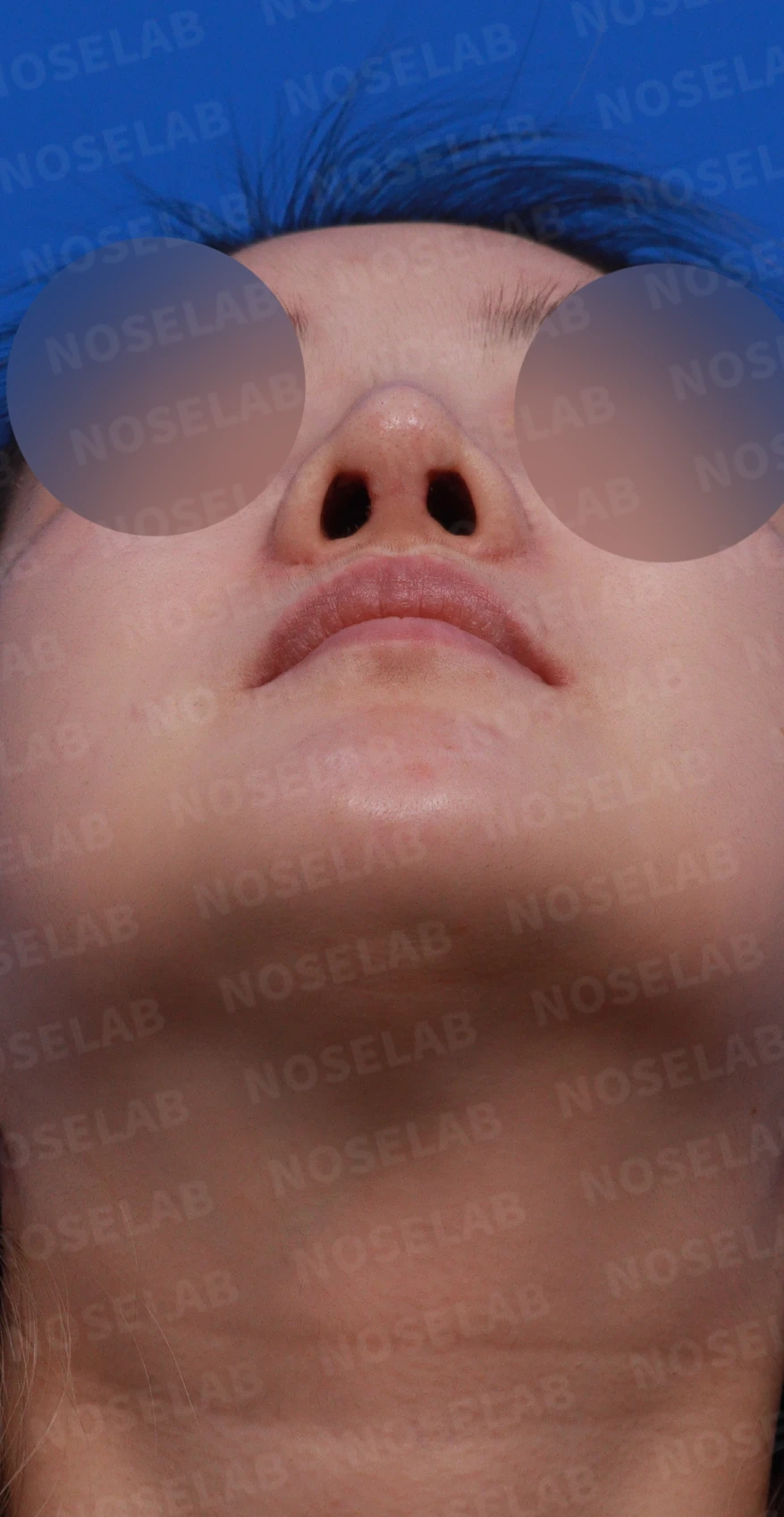 코재수술 뒤 콧대가 붉어 보이는 이유와 재건 방법 — 디자인 상담 우측 측면, 비스듬한 측면, 비공 사진