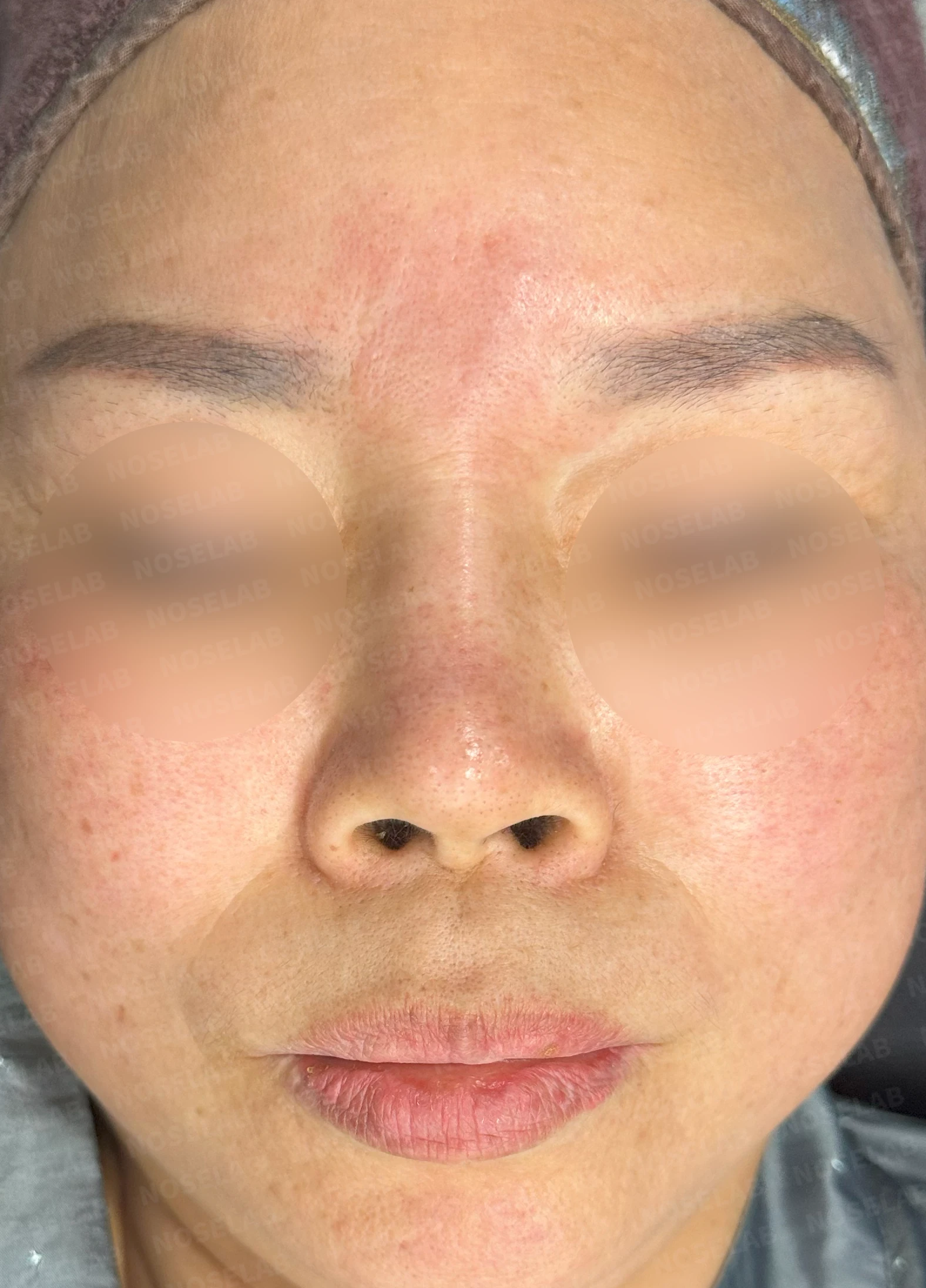 불법 주사 시술 뒤 코가 들리고 짧아지는 이유, 이물질 제거와 재건은 어떻게 하나 — 수술 전 / 수술 직후 0일 직후 사진은 부기가 있는 상태로 최종 결과와 다를 수 있습니다.
