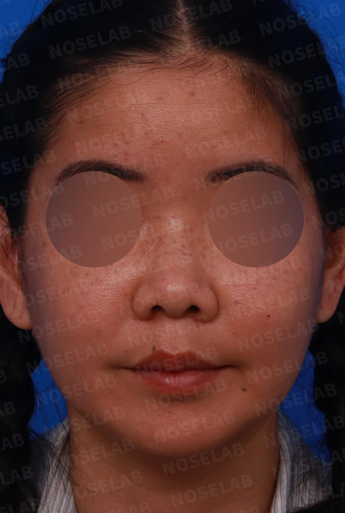 콧대가 평행선처럼 보이는 조건과 콧구멍 모양을 정하는 기준 — 디자인 상담 정면 , 좌측 비스듬한 측면 , 측면 사진입니다.