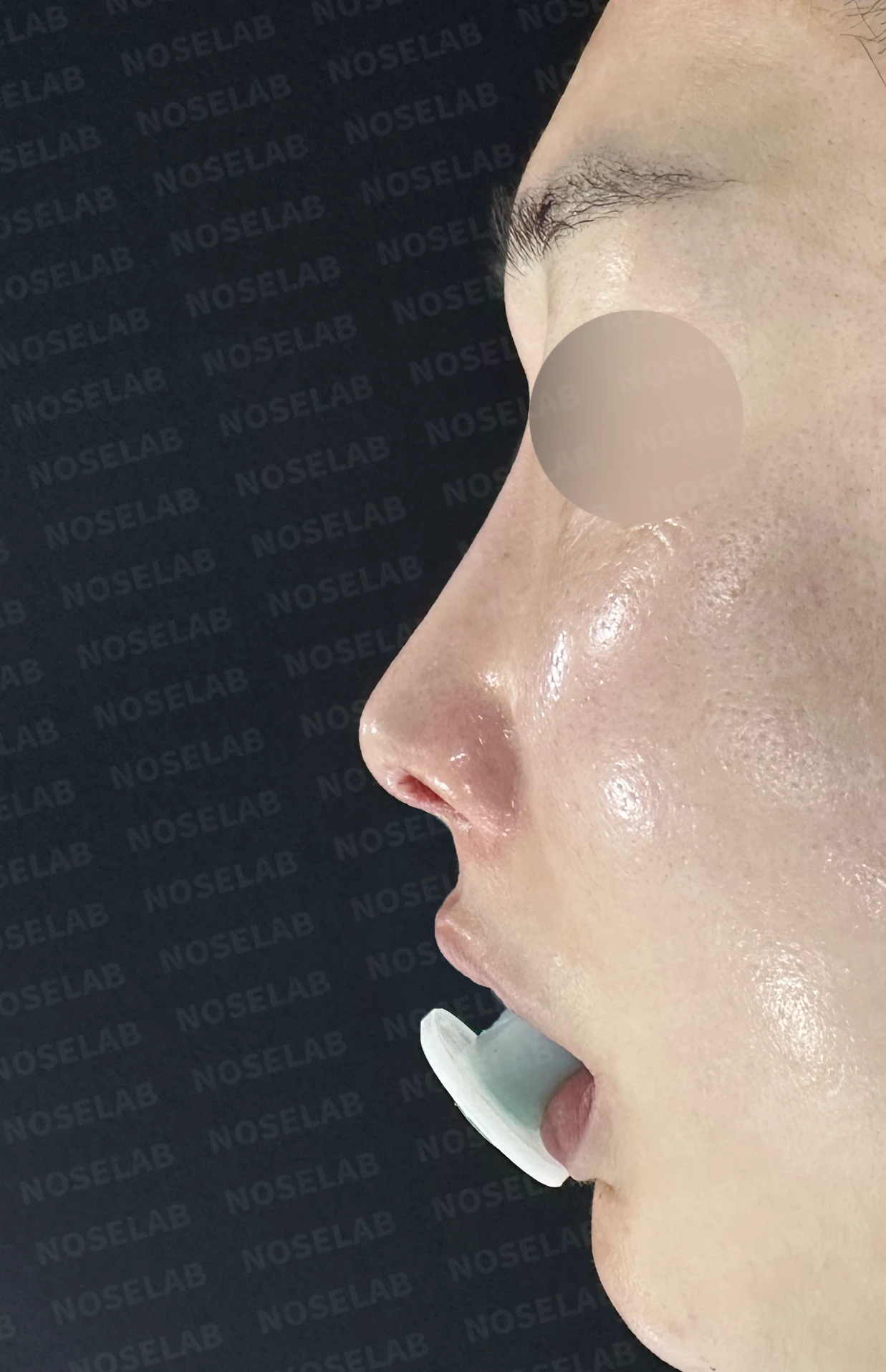실리콘이 휘고 코가 길어 보이는 이유, 보형물 교체와 늑연골 재건은 어떻게 하나 — 수술 전 / 수술 직후 0일 직후 사진은 부기가 있는 상태로 최종 결과와 다를 수 있습니다.