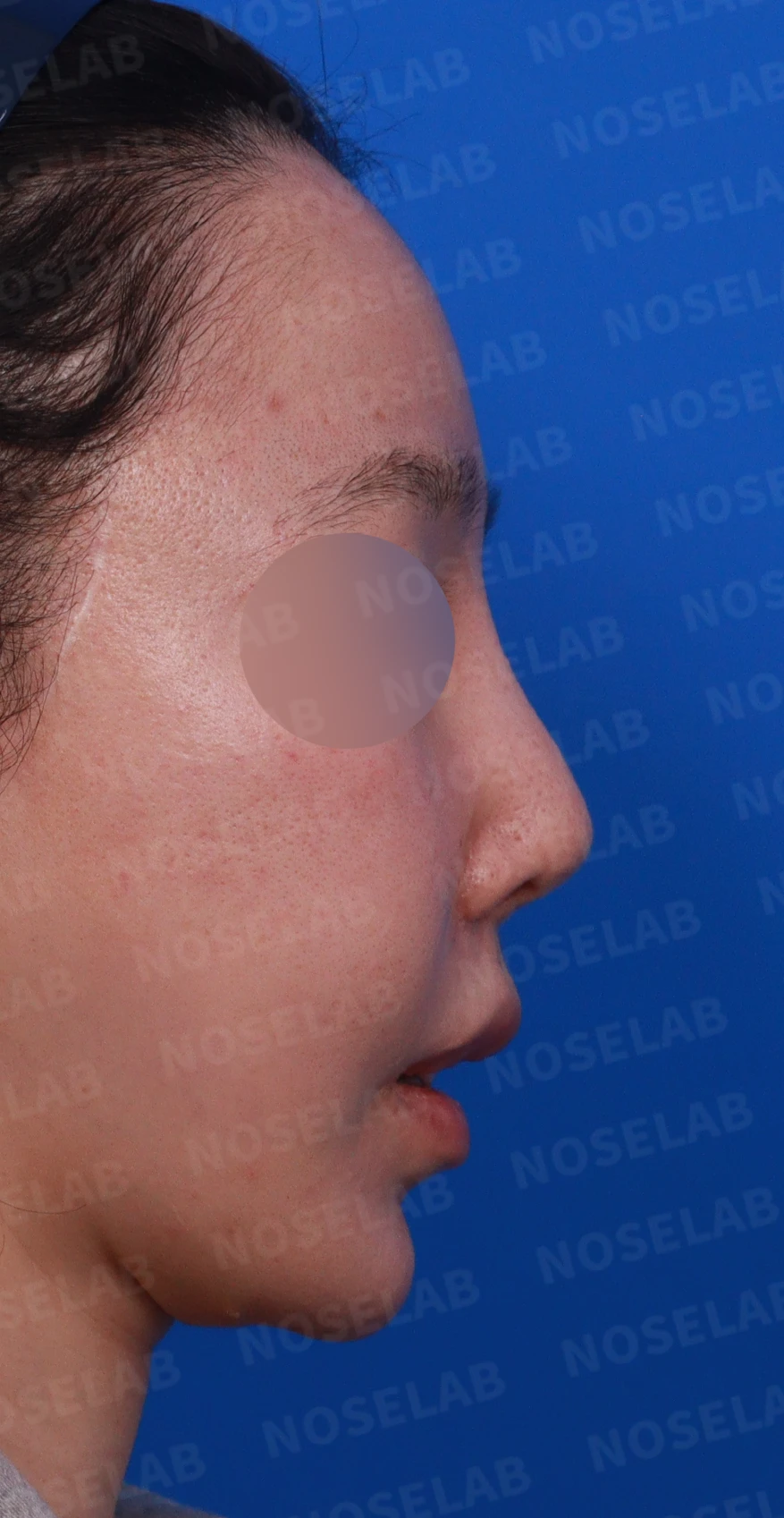콧대가 뭉툭하게 퍼져 보이는 만성 이물 반응, 원인과 재건 방법 — 디자인 상담 우측 비스듬한 측면, 측면, 비공 사진