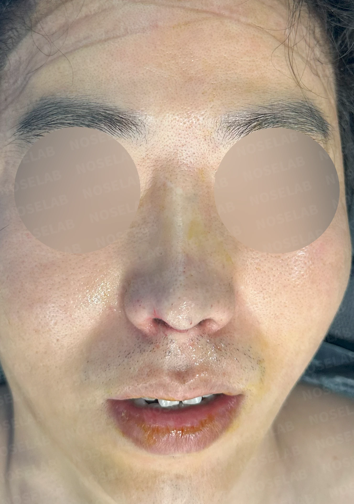코끝 염증을 겪은 뒤 콧날개가 찝히고 코끝이 꺼지는 이유와 재건 방법 — 수술 전 / 수술 직후 0일 직후 사진은 부기가 있는 상태로 최종 결과와 다를 수 있습니다.