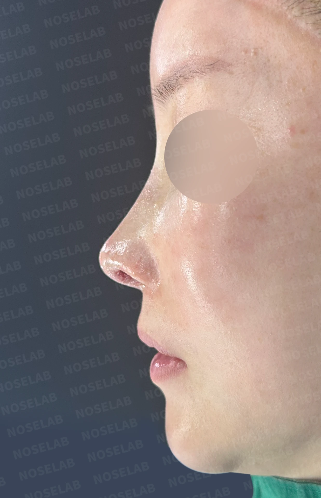귀족수술 보형물이 코 안으로 밀려 나와 숨이 막히는 이유와 재건 방법 — 본문 사진 11