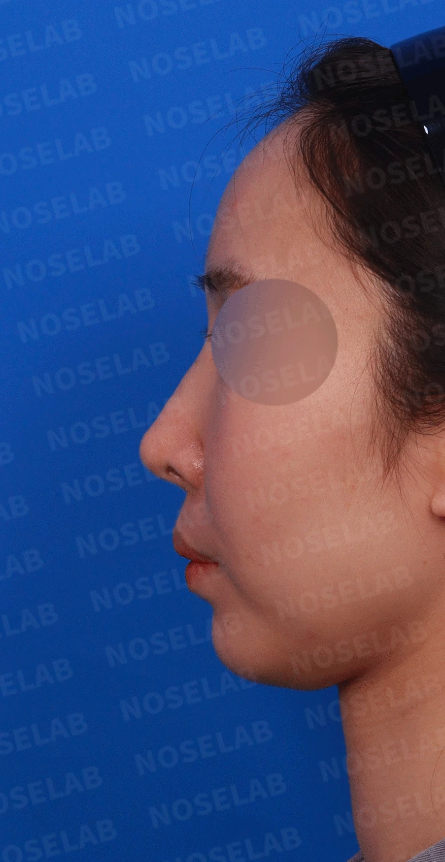 코성형 절골 후 콧등이 꺼지고 한쪽이 막히는 이유, 비밸브 재건과 복원 — 디자인 상담 정면 , 좌측 비스듬한 측면 , 측면 사진입니다.