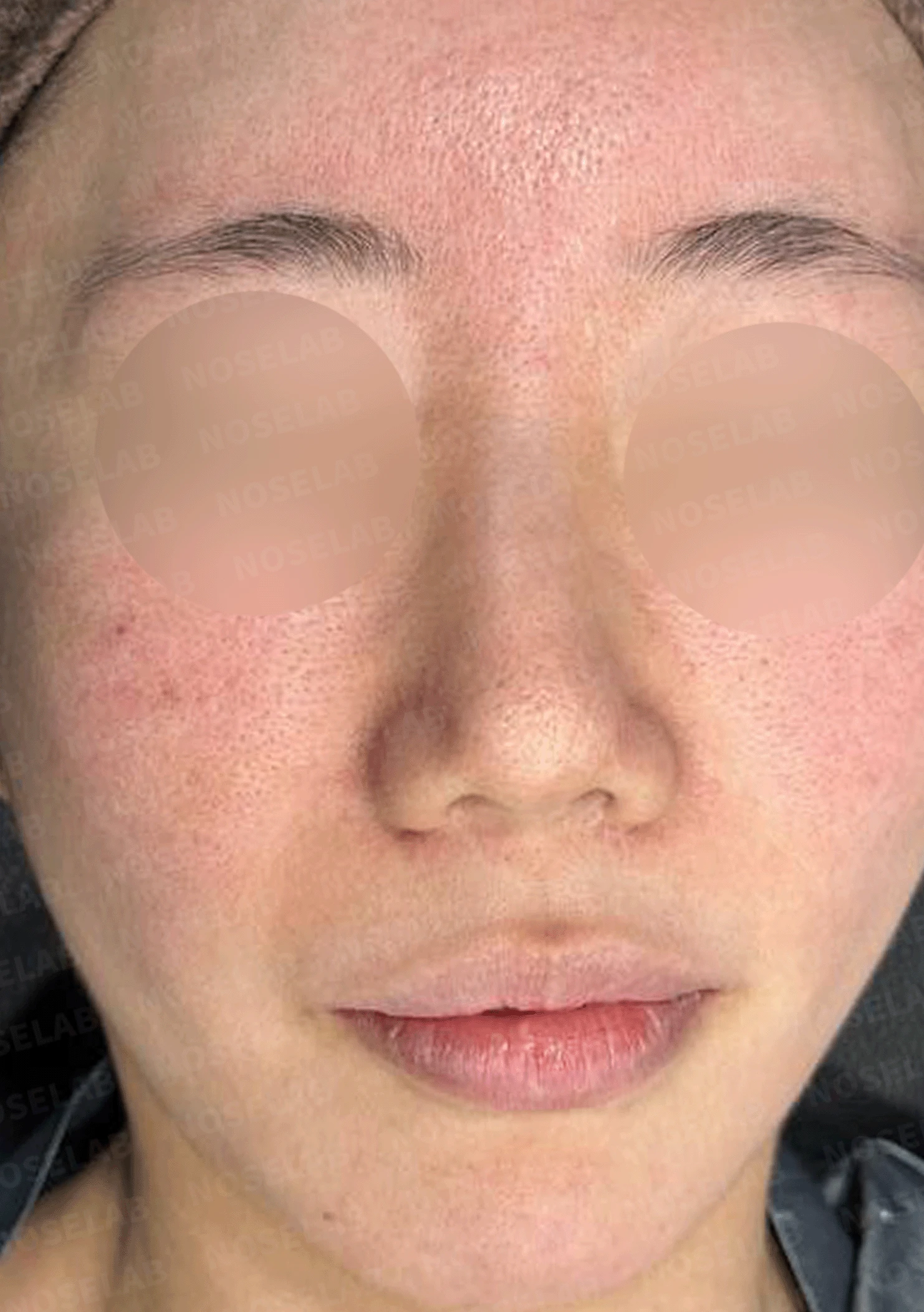 오래된 코 수술 뒤 비주가 함몰되고 코끝이 뭉툭해지는 이유와 재건 방법 — 본문 사진 7