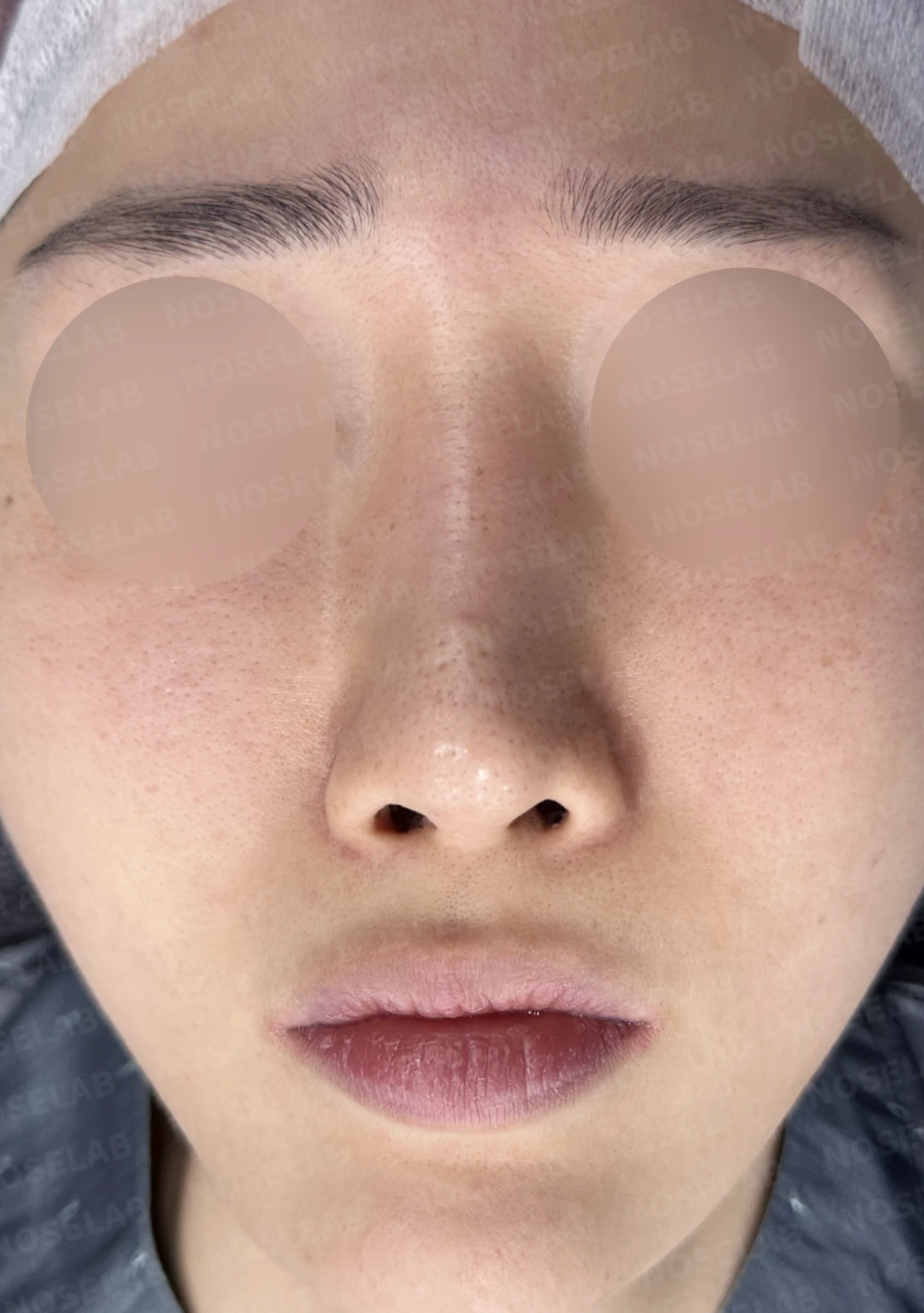 실리콘이 휘고 코가 길어 보이는 이유, 보형물 교체와 늑연골 재건은 어떻게 하나 — 수술 전 / 수술 직후 0일 직후 사진은 부기가 있는 상태로 최종 결과와 다를 수 있습니다.
