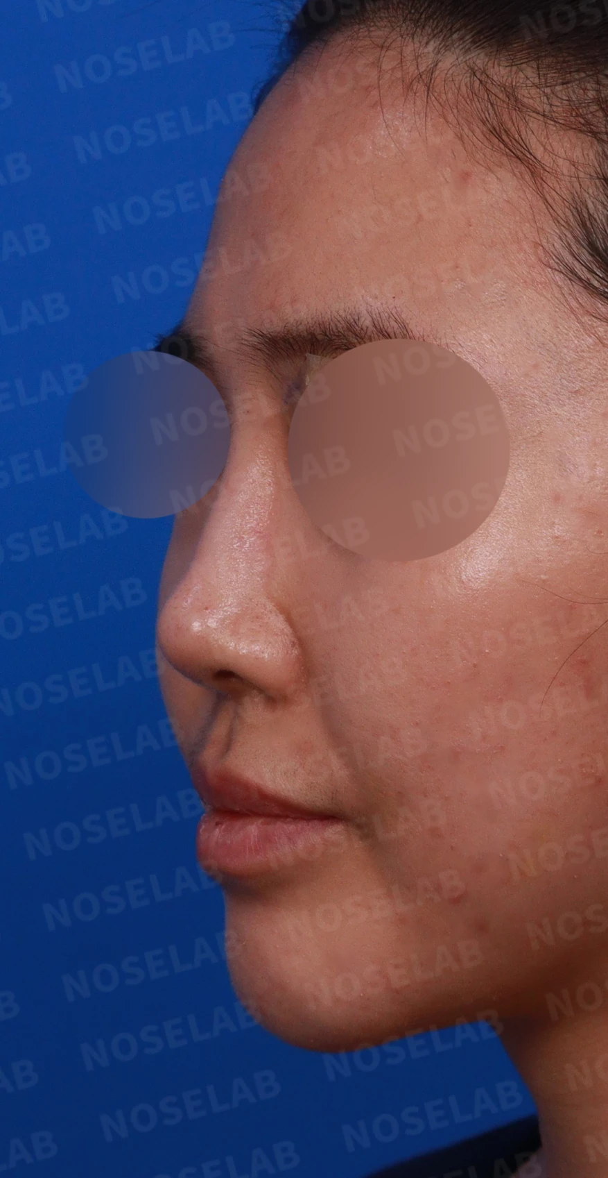 코필러 제거, 코막힘 해결 사례 — 디자인 상담 정면, 좌측 측면, 비스듬한 측면 사진