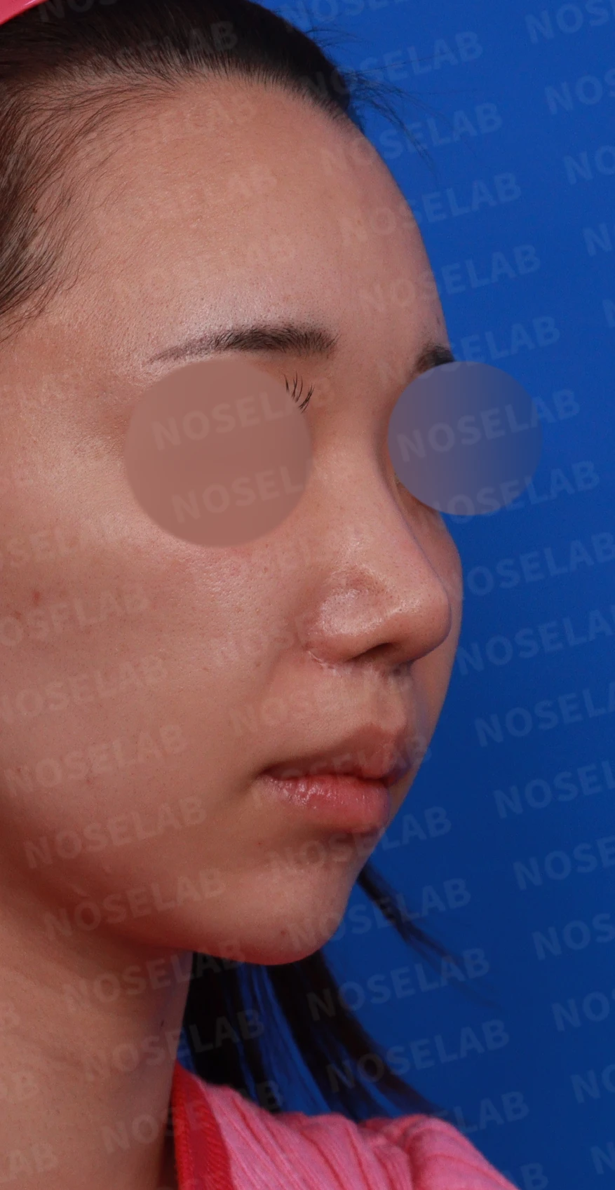 콧구멍 비대칭과 협착이 생기는 이유, 늑연골 재건과 Z성형은 어떻게 하나 — 디자인 상담 우측 비스듬한 측면, 측면, 비공 사진입니다.