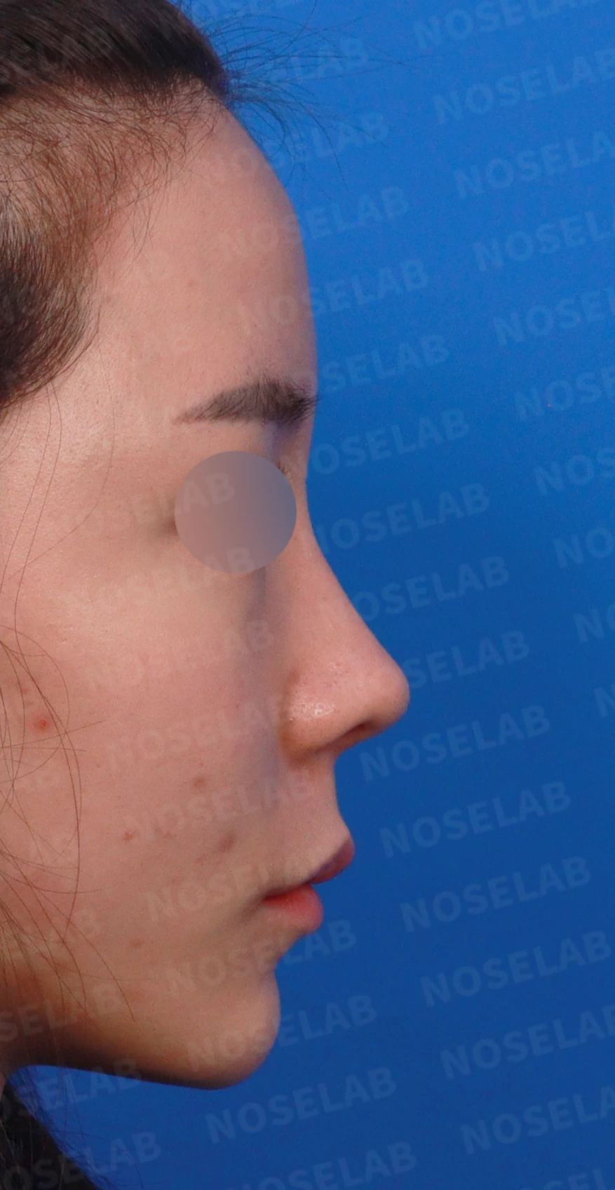 비주가 길어 보이는 이유와 코끝 연골 재배치 방법 — 디자인 상담 정면, 좌측 측면, 비스듬한 측면 사진입니다.