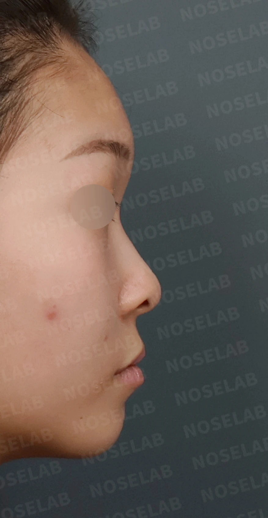 낮고 퍼진 코, 기증늑연골과 실리콘 보형물로 자연스러운 코 라인 완성 — 디자인 상담 우측 측면, 비스듬한 측면, 비공 사진입니다.