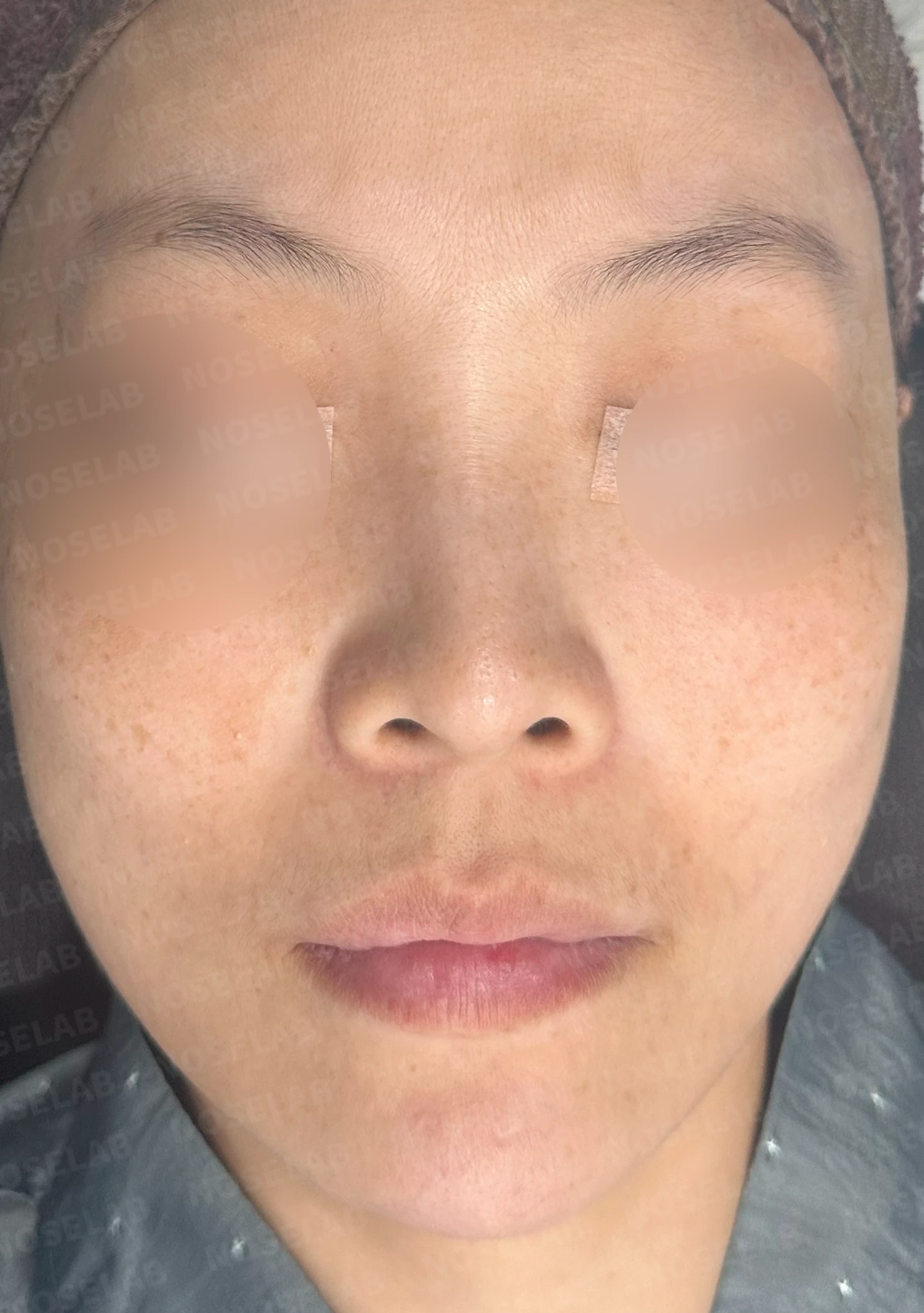 첫 코성형에서 코끝 구조와 콧구멍 노출은 어떻게 다루나 — 수술 전 / 수술 직후 0일 직후 사진은 부기가 있는 상태로 최종 결과와 다를 수 있습니다.