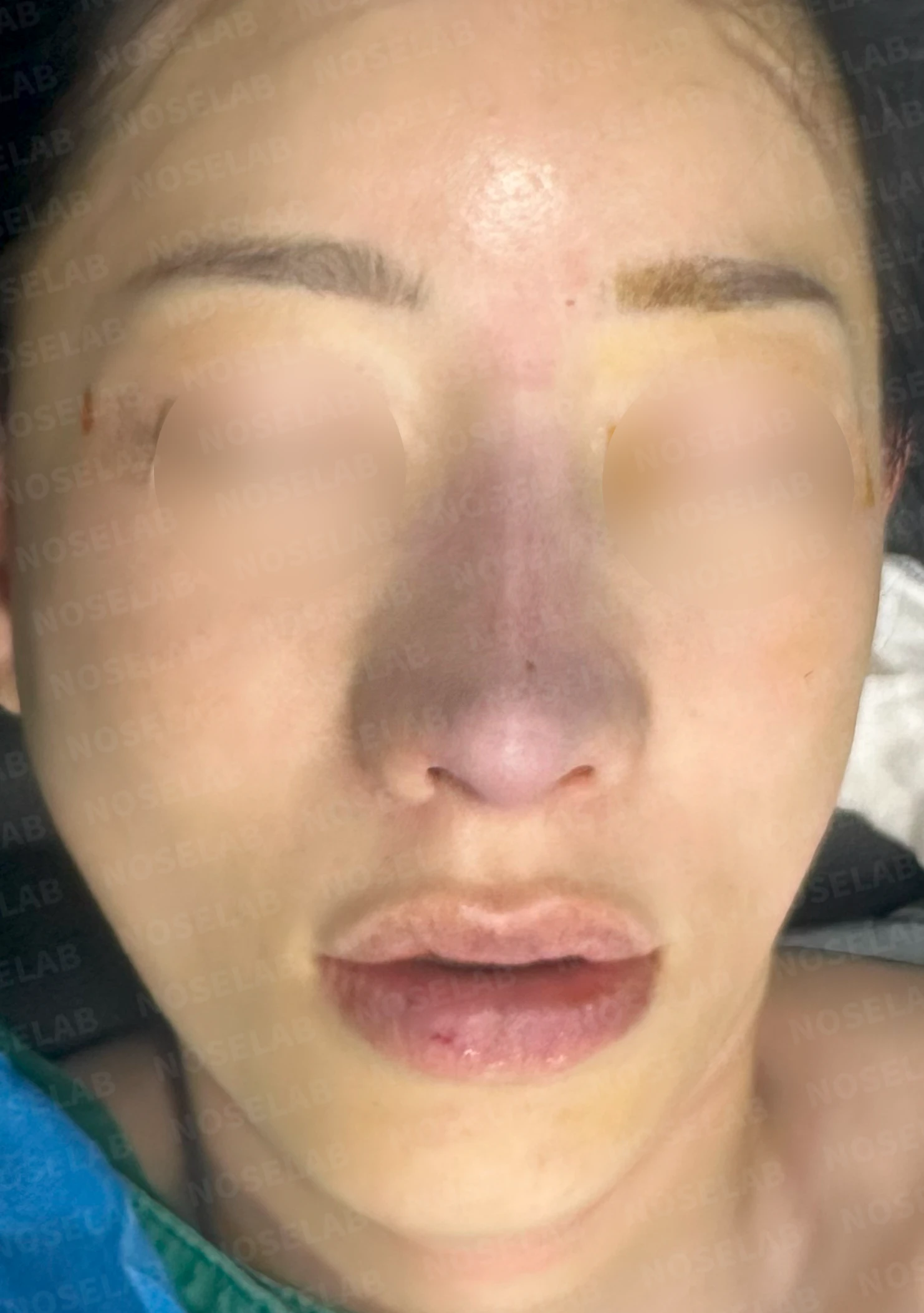충격을 받은 뒤 코끝에서 소리가 나고 모양이 달라지는 이유와 늑연골 재건 — 수술 전 / 수술 직후 0일 직후 사진은 부기가 있는 상태로 최종 결과와 다를 수 있습니다.