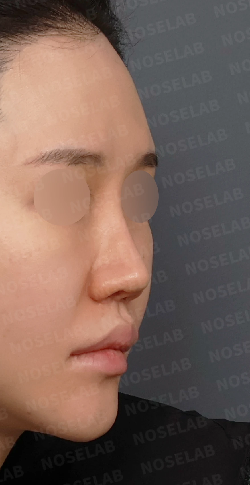 콧구멍 좌우가 심하게 달라 보이는 이유, 연골 재건과 피부이식 교정은 어떻게 하나 — 디자인 상담 우측 측면, 비스듬한 측면, 비공 사진입니다.
