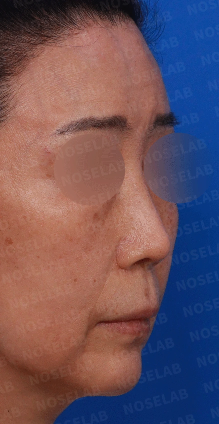 여러 차례 수술에도 코가 계속 휘는 이유, 비중격 연골 재건 방법 — 디자인 상담 우측 측면 , 비스듬한 측면 , 비공 사진입니다.