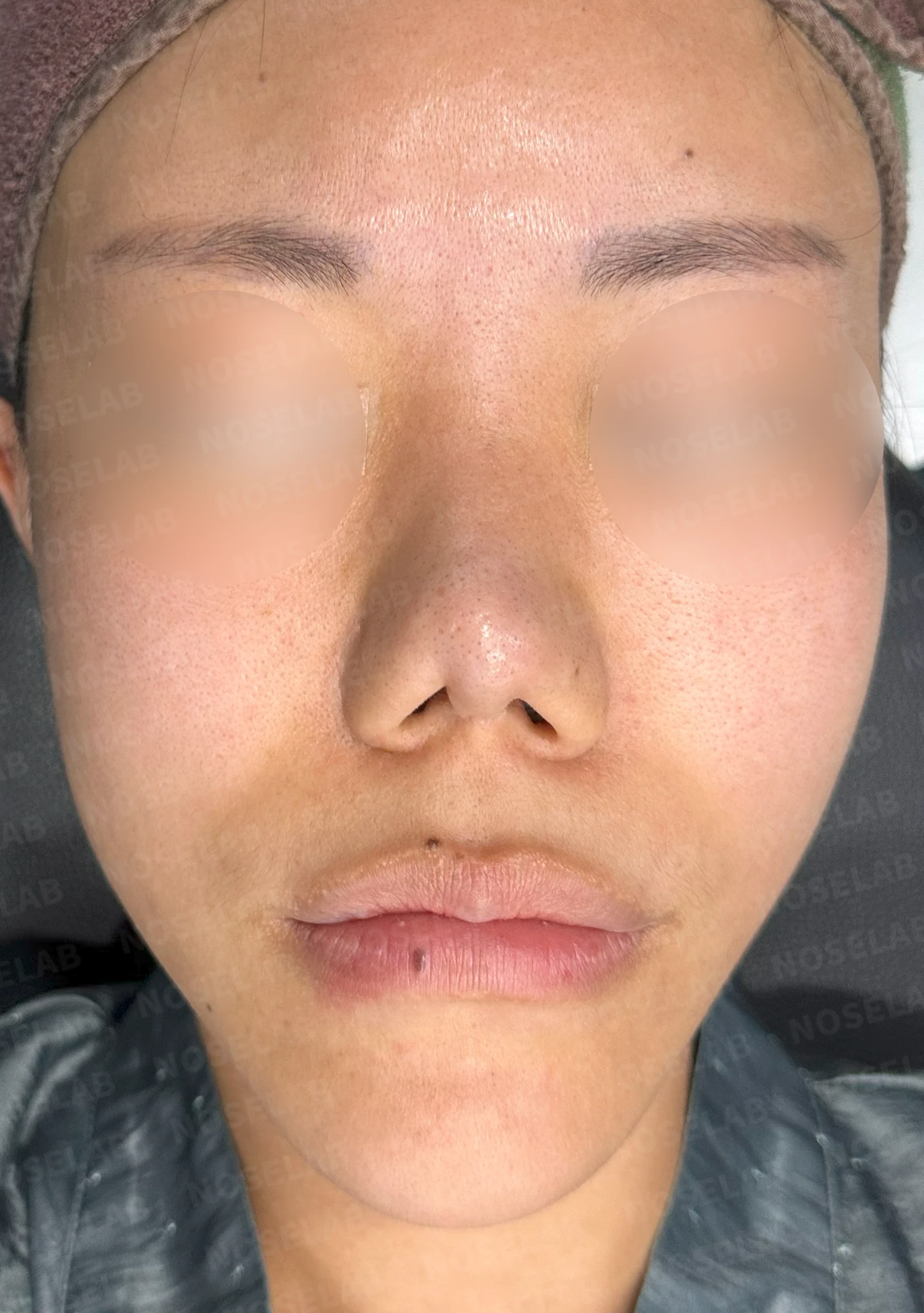 코성형 뒤 감염이 반복되는 이유, 염증 치료와 단계적 재건은 어떻게 하나 — 수술 전 / 수술 직후 0일 직후 사진은 부기가 있는 상태로 최종 결과와 다를 수 있습니다.