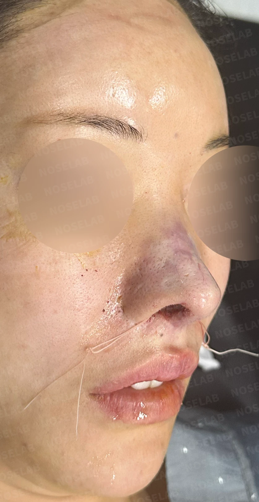 코 수술 뒤 콧등 피부가 괴사하면 어떤 변화가 남고, 재건은 어떻게 하나 — 수술 직후 0일 정면 , 측면 , 비스듬한 측면 사진 직후 사진은 부기가 있는 상태로 최종 결과와 다를 수 있습니다.