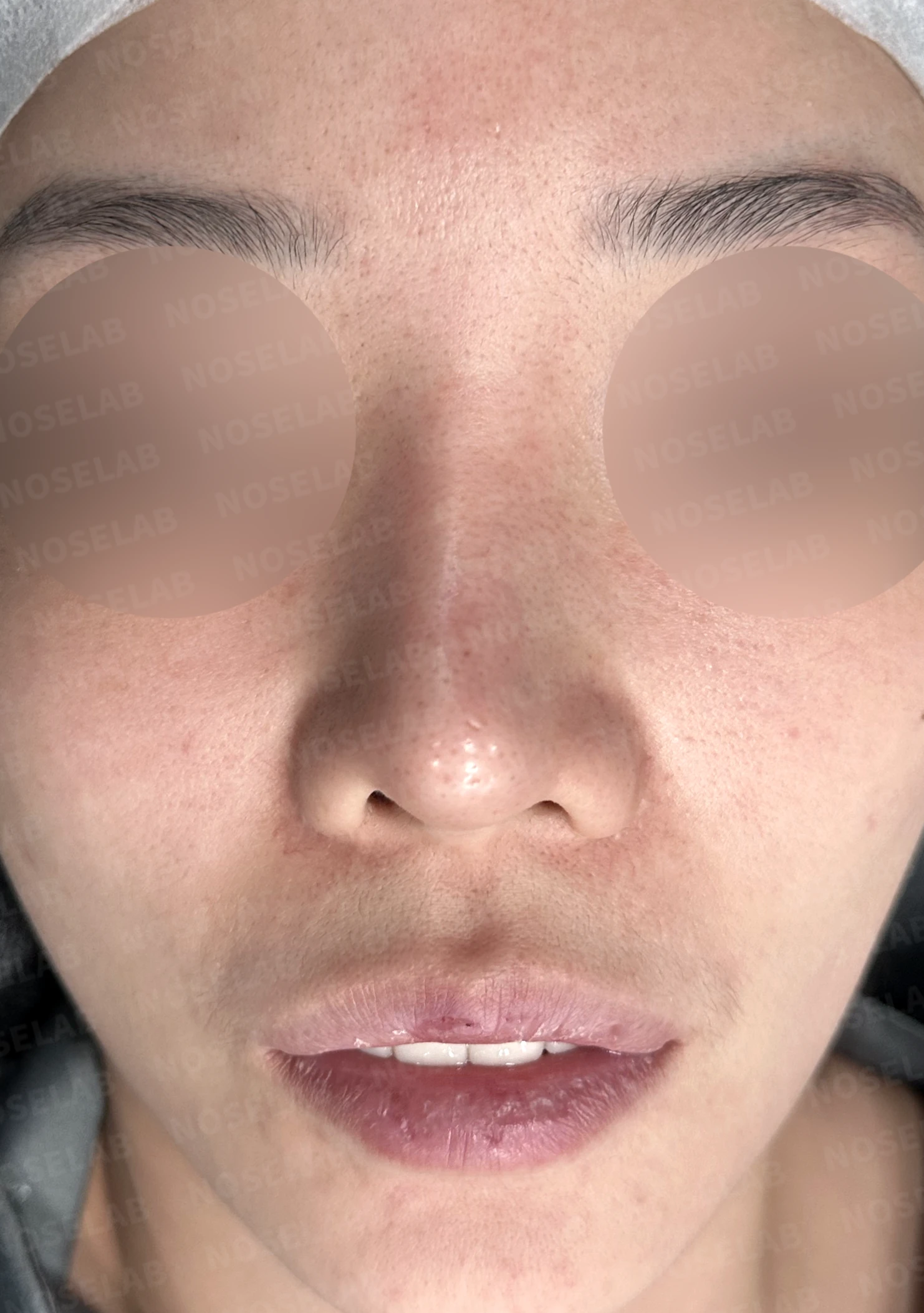 휘어진 코와 퍼진 코끝, 자가늑연골로 세련된 직반라인 완성한 코재수술 — 전(좌) 직후(후)