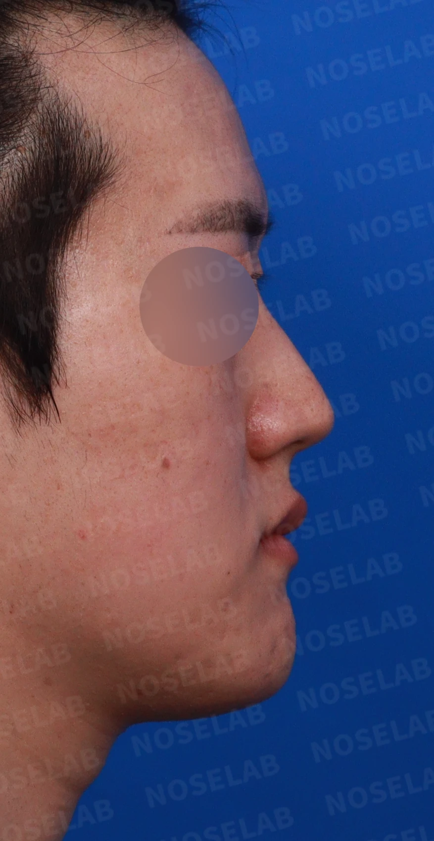 보형물 없이 코끝과 경계 부분만 교정하는 방법 — 디자인 상담 비스듬한 측면 , 우측 측면, 비공 사진