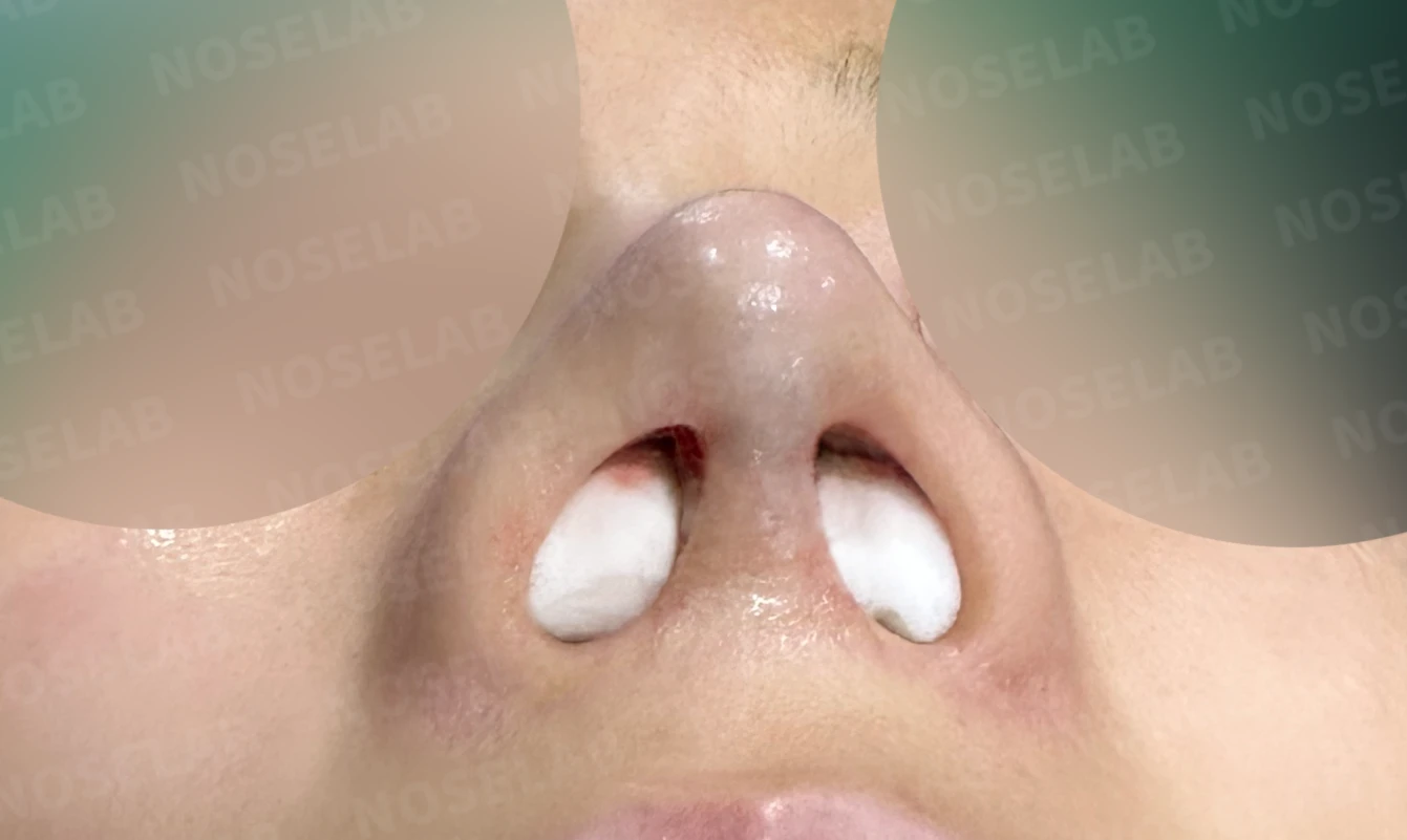 비중격 천공이 생기면 무엇이 문제이고 어떻게 재건하나 — 수술 직후 0일 비공 사진입니다. 직후 사진은 부기가 있는 상태로 최종 결과와 다를 수 있습니다.