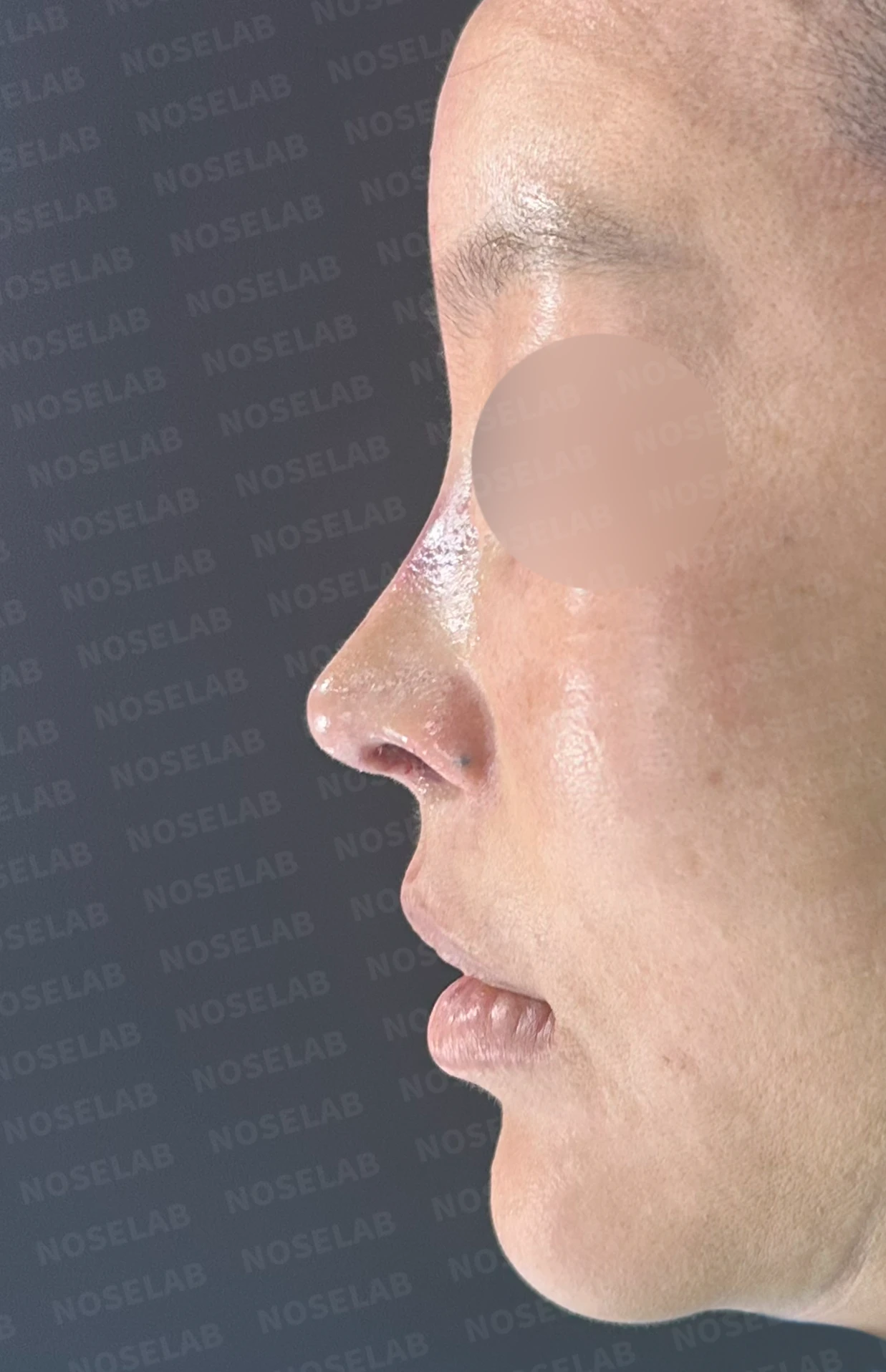 이식한 진피가 흡수되어 콧대가 퍼지고 코가 들려 보이는 이유와 교정 방법 — 수술 직후 0일 정면, 비스듬한 측면, 측면 사진입니다. 직후 사진은 부기가 있는 상태로 최종 결과와 다를 수 있습니다.