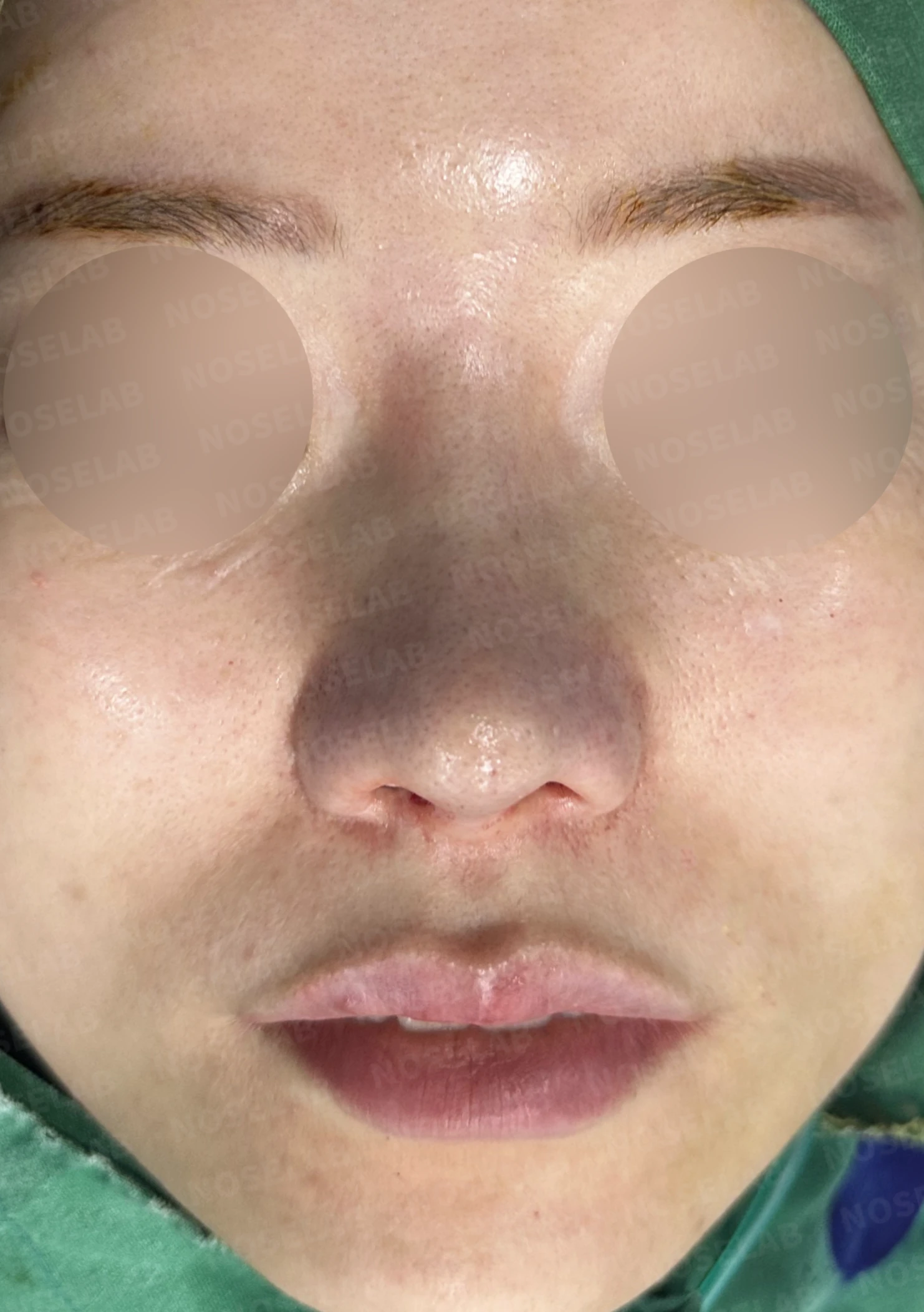 짧은 코와 복코, 자가늑연골로 세련되게 교정한 코재수술 — 전(좌) 직후(후)