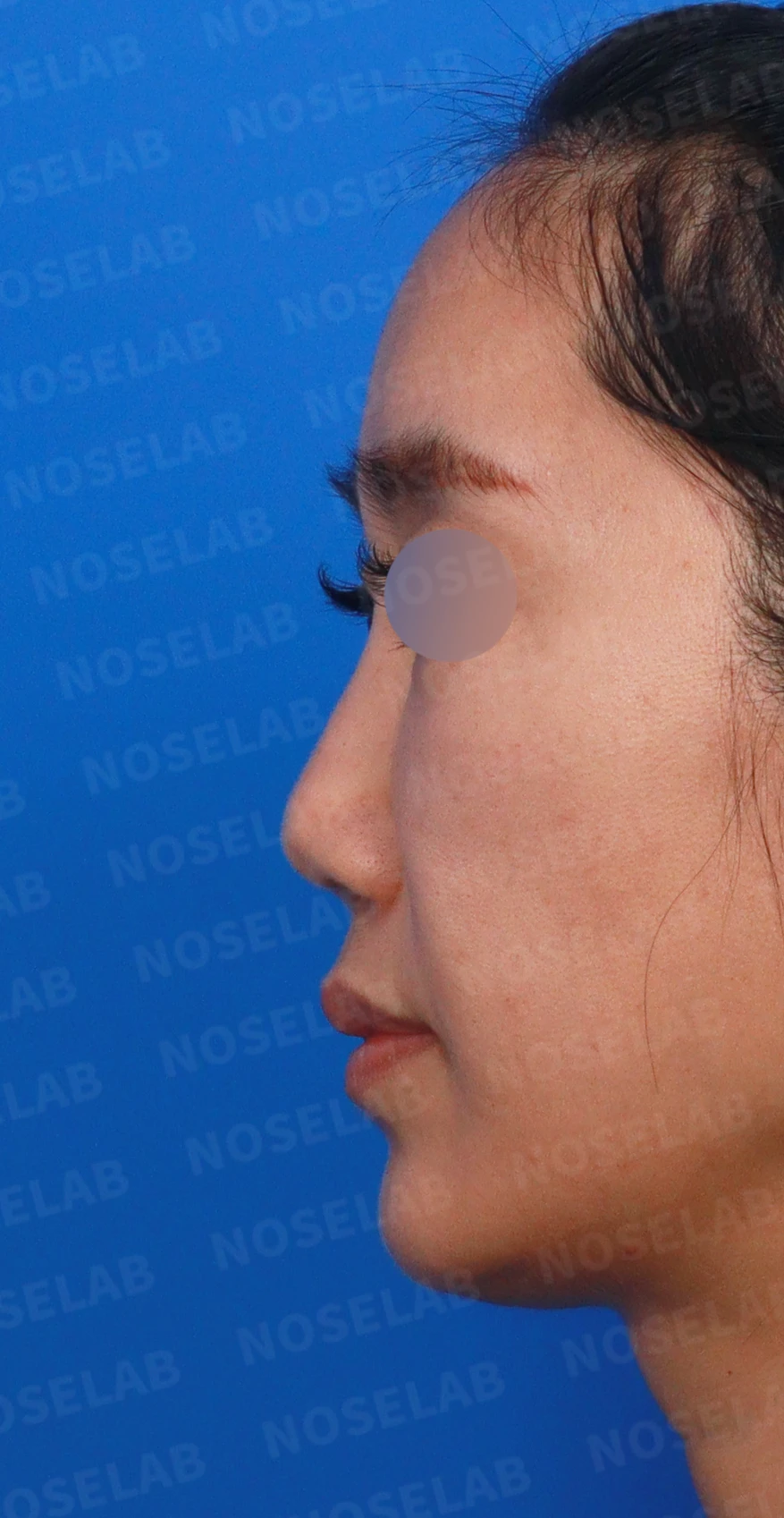 콧대에 주입한 불법 시술 이물질, 제거와 비중격 전체 재건은 어떻게 하나 — 디자인 상담 정면, 좌측 비스듬한 측면, 측면 사진입니다.