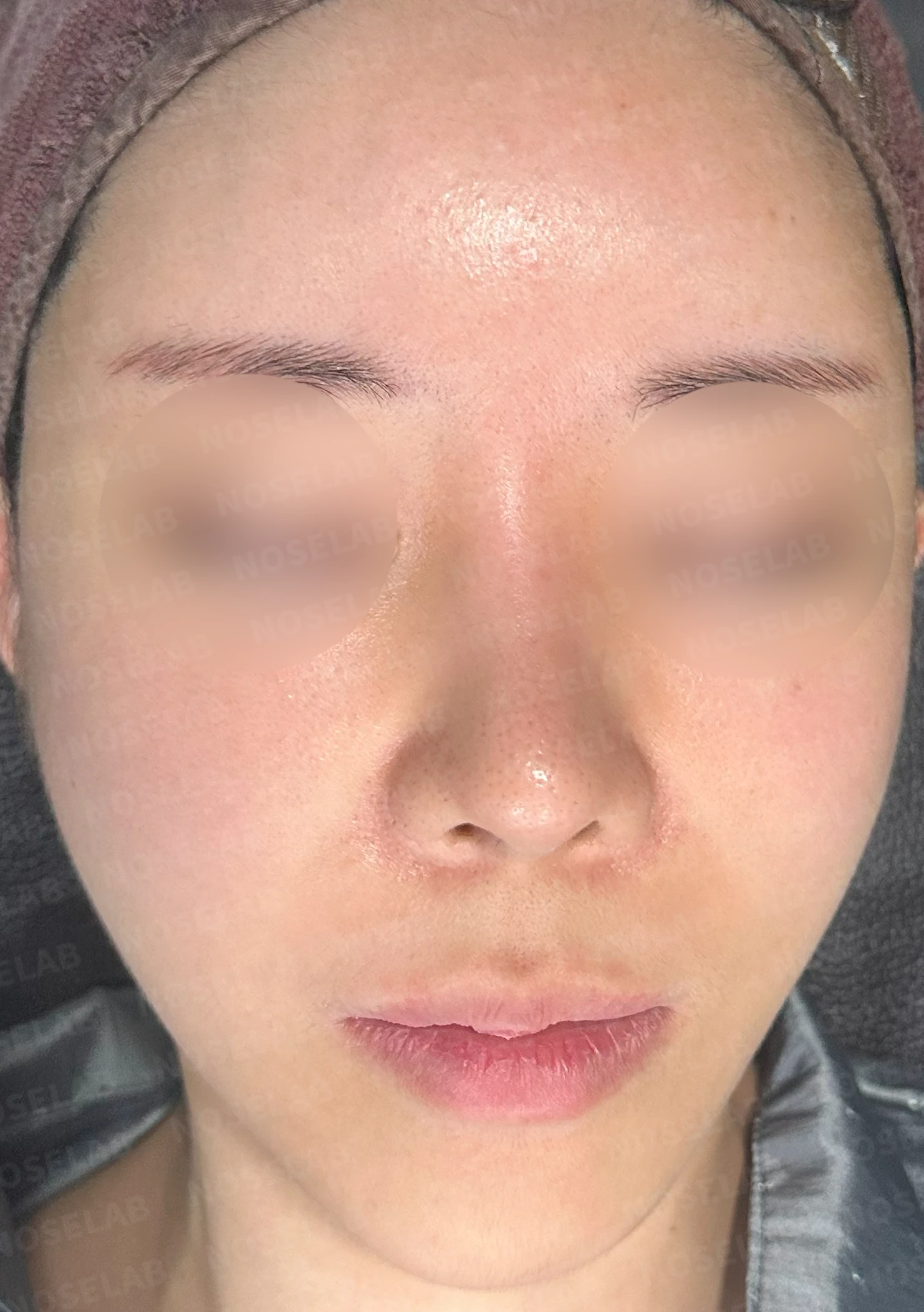 다섯 번의 수술 끝에 찾은 완벽한 코: 들린코와 휜코의 극적인 변신 — 수술전(좌) 수술직후(우)