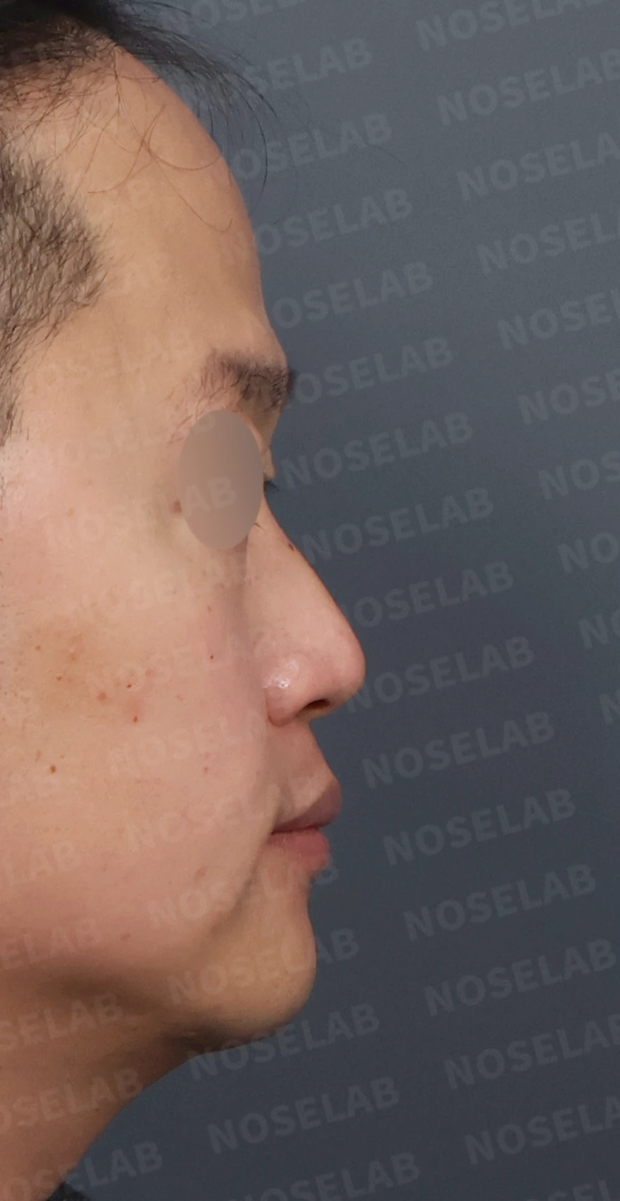 코막힘과 휘어진 비중격, 자가늑연골로 기능과 모양을 동시에 개선 — 디자인 상담 우측 측면, 비스듬한 측면, 비공 사진입니다.