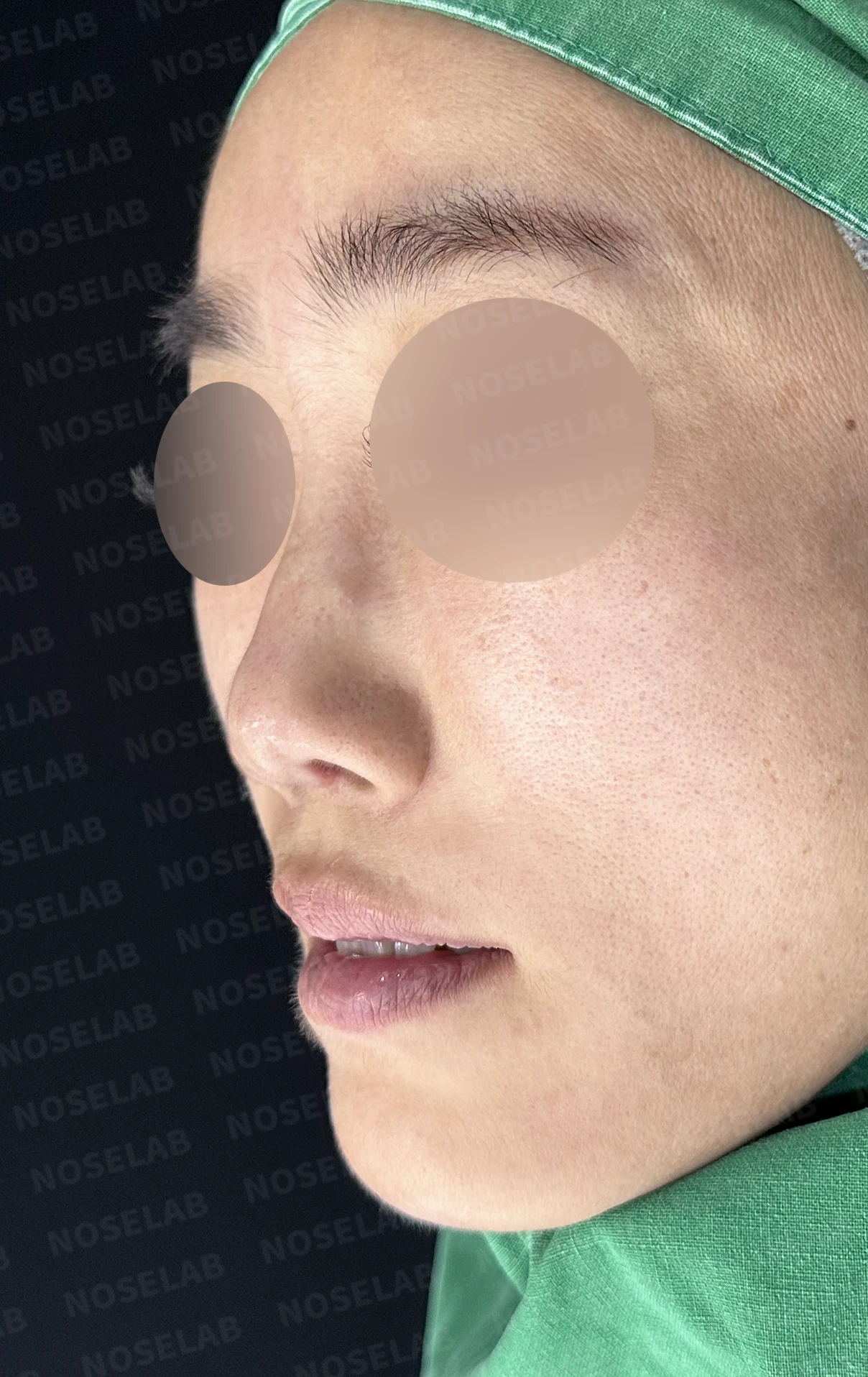 콧대에 주입한 불법 시술 이물질, 제거와 비중격 전체 재건은 어떻게 하나 — 수술 전 / 수술 직후 0일 직후 사진은 부기가 있는 상태로 최종 결과와 다를 수 있습니다.