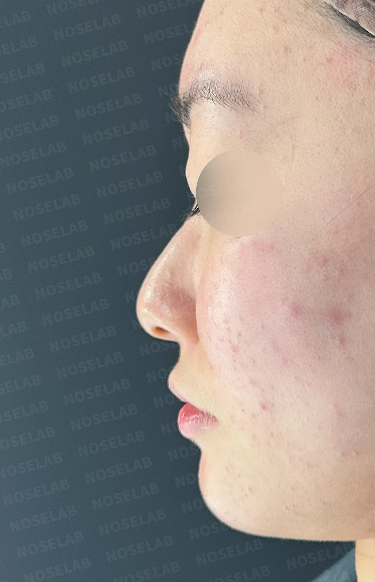 코끝이 뭉툭하게 퍼지고 코가 휘어 보이는 이유, 늑연골 재건은 어떻게 하나 — 수술 전 / 수술 직후 0일 직후 사진은 부기가 있는 상태로 최종 결과와 다를 수 있습니다.