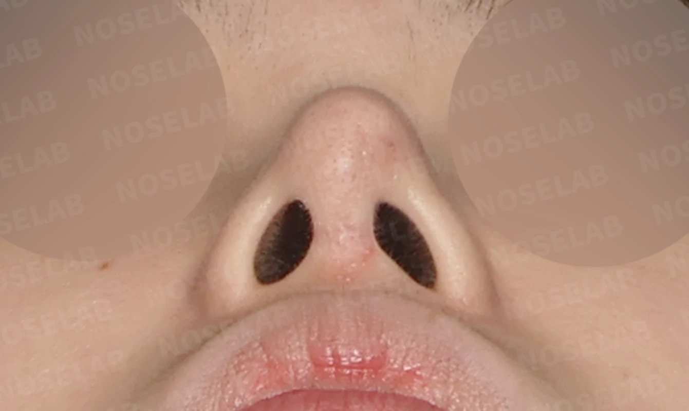 보형물 비침과 비대칭, 자가늑연골 코재수술로 자연스럽게 교정한 사례 — 전(좌) 직후(후)