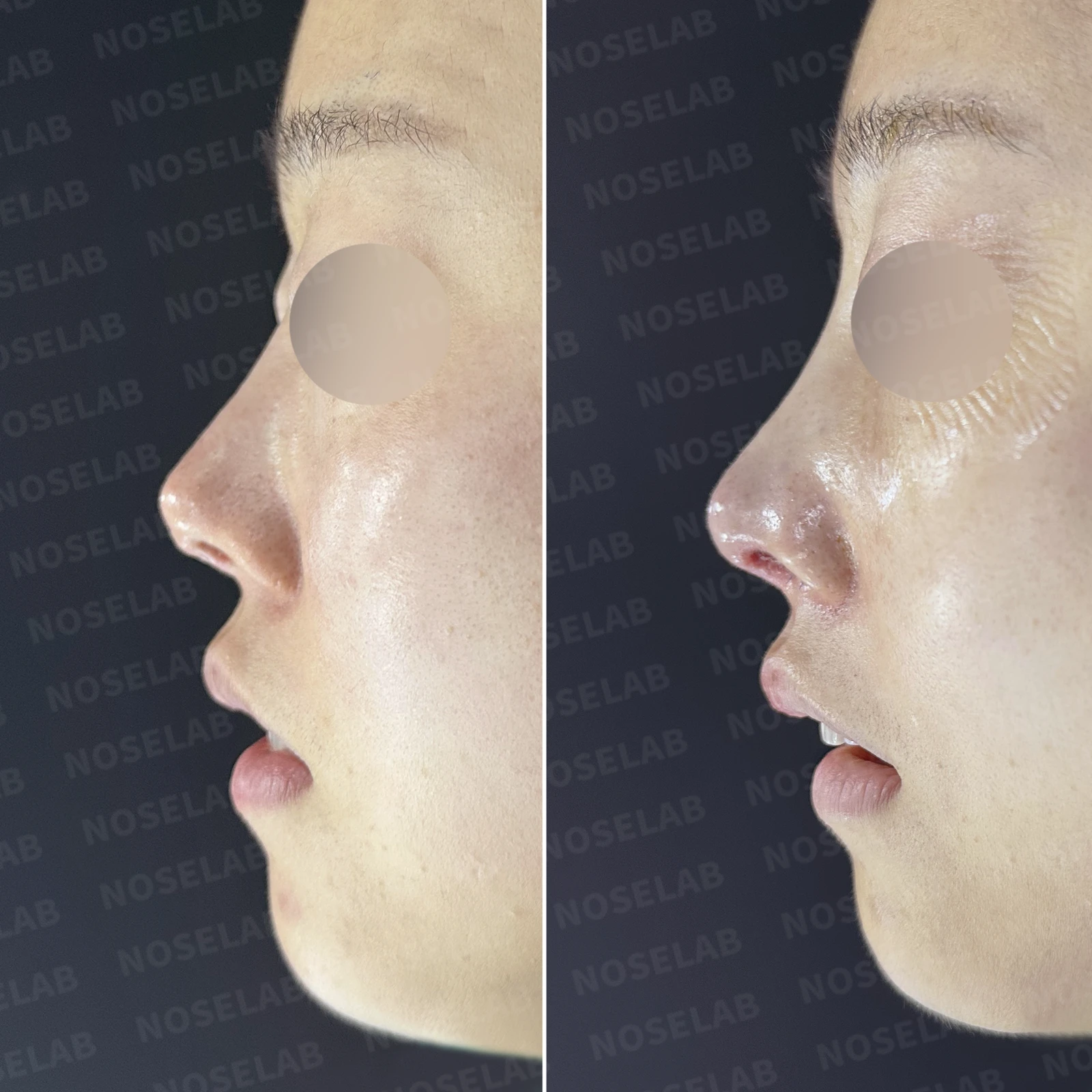 코끝 피부가 얇아져 연골이 비치는 이유, 피부 보강은 어떻게 하나 — 본문 사진 21