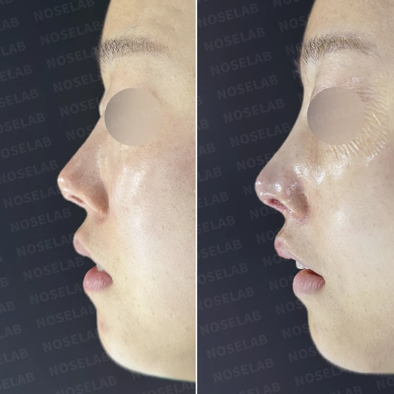 얇아진 피부 보강하며 완성한 자연스러운 코, 들린코와 비공 비대칭까지 — 전후 비교