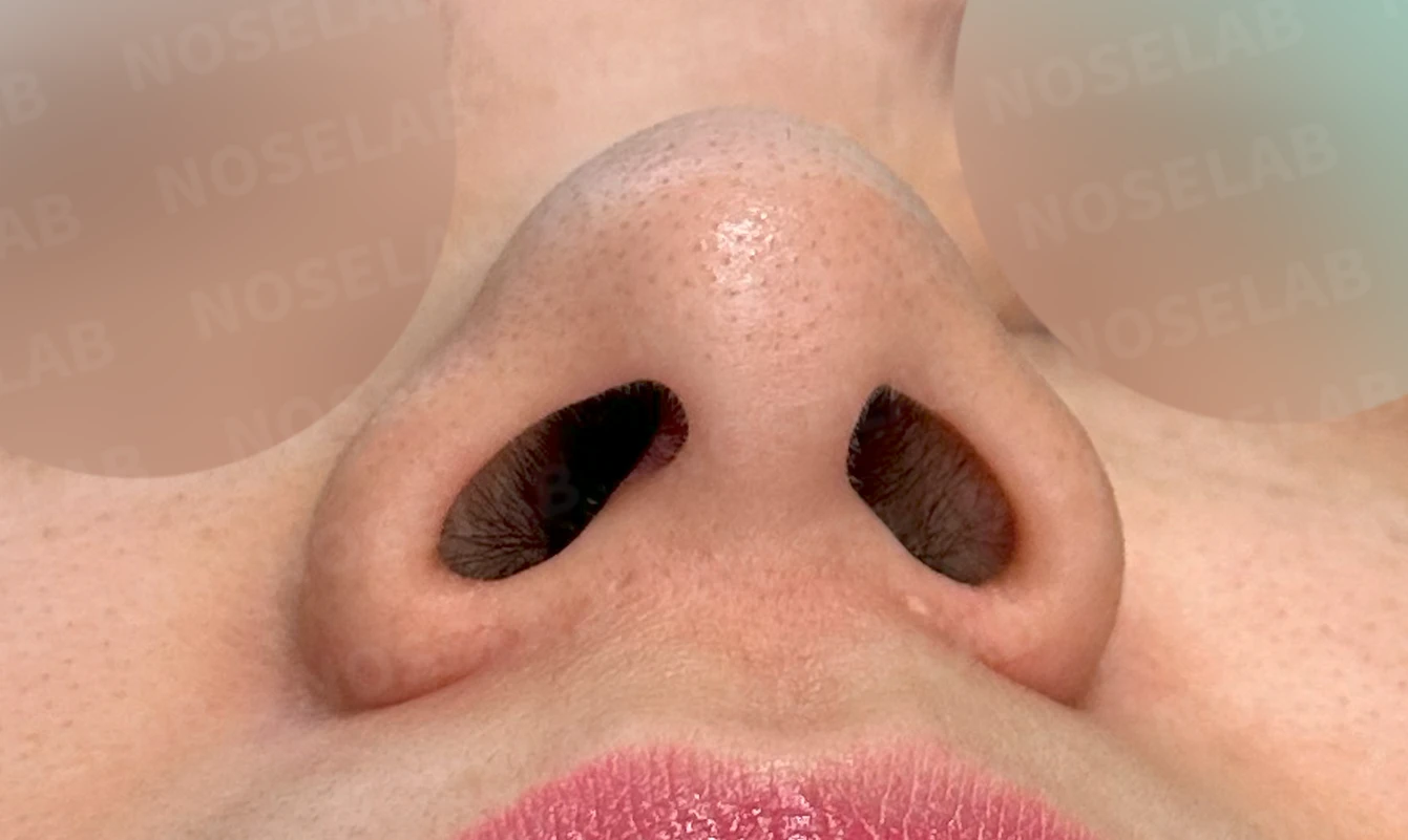 복코, 퍼진코 교정 방법 — 수술 전 / 수술 직후 0일 직후 사진은 부기가 있는 상태로 최종 결과와 다를 수 있습니다.