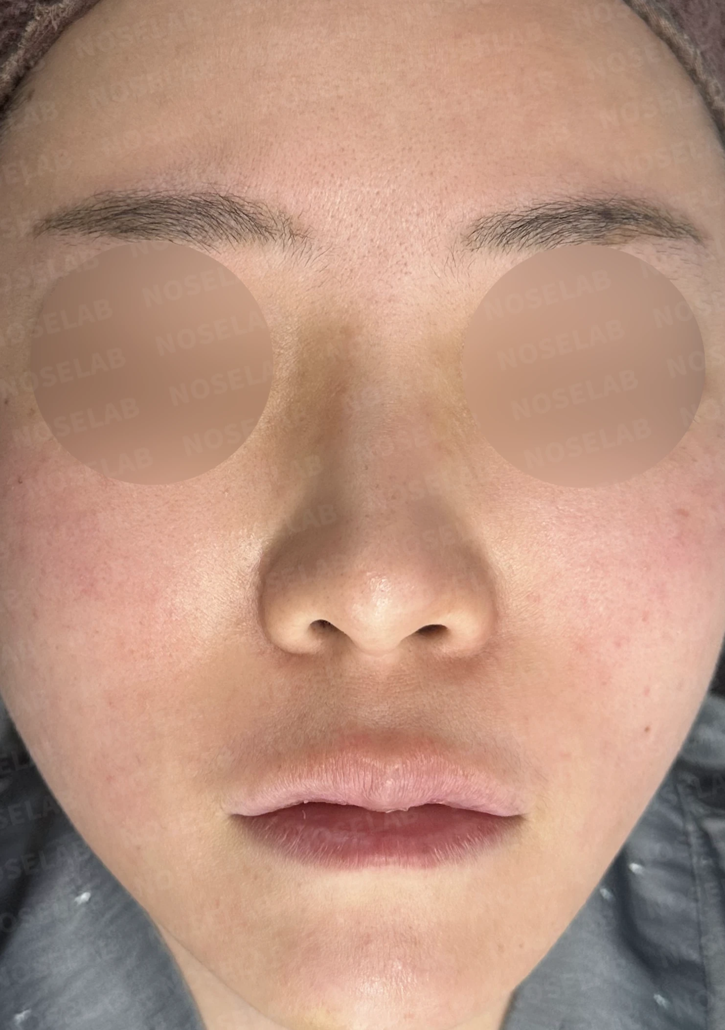 들린코 교정과 코막힘 개선, 자가늑연골로 코재수술 후기 — 전(좌) 직후(후)