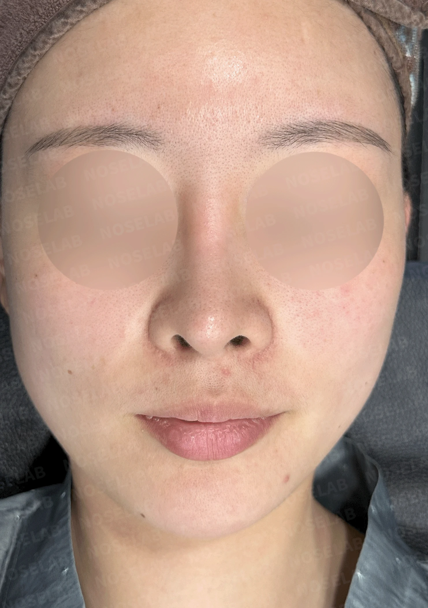 콧대가 인위적으로 보이고 코가 들리는 이유, 재건은 어떻게 하나 — 본문 사진 7