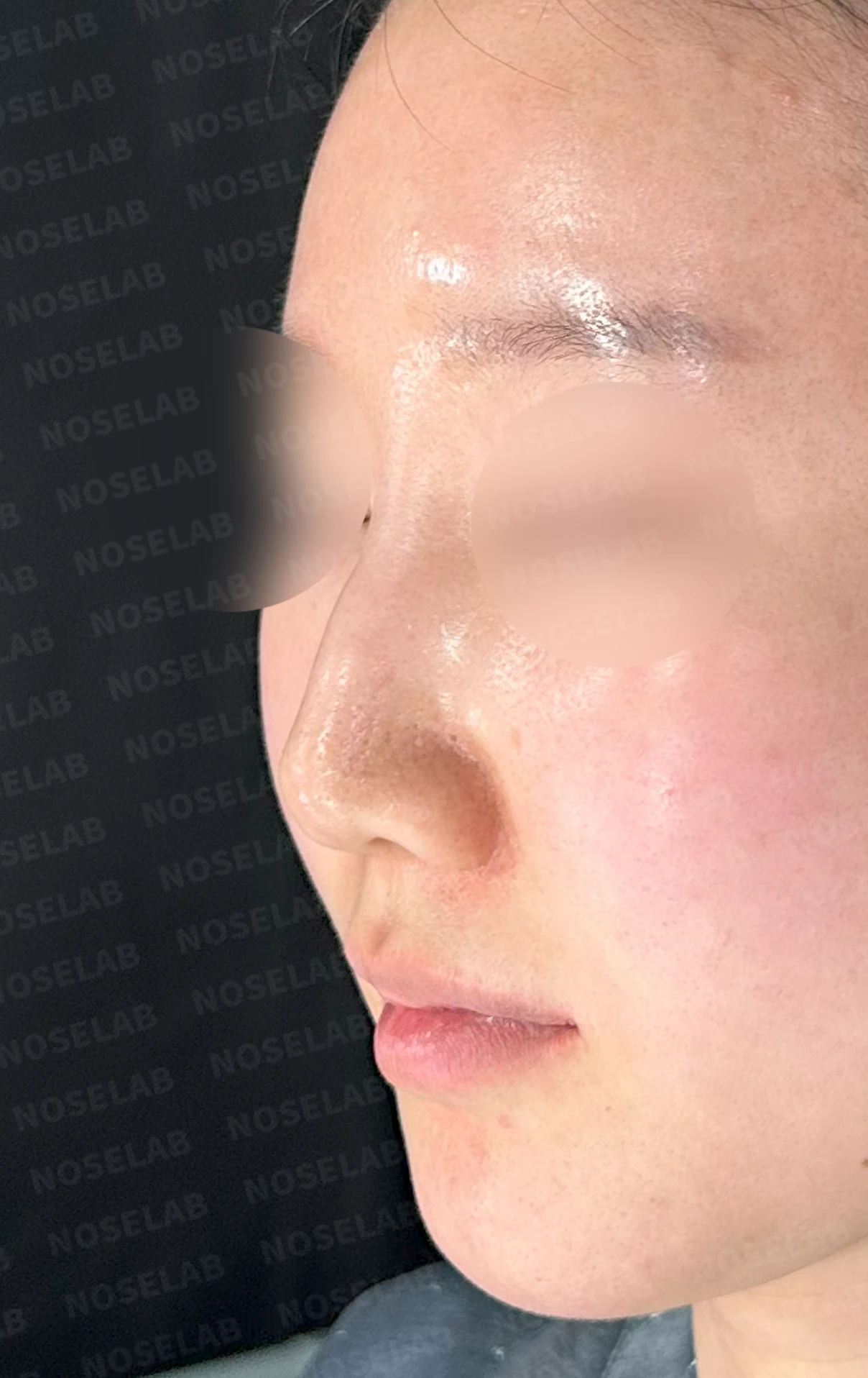 비공 비대칭과 코끝 처짐은 왜 생기나, 연골을 병용한 재건 방법 — 수술 전 / 수술 직후 0일 직후 사진은 부기가 있는 상태로 최종 결과와 다를 수 있습니다.