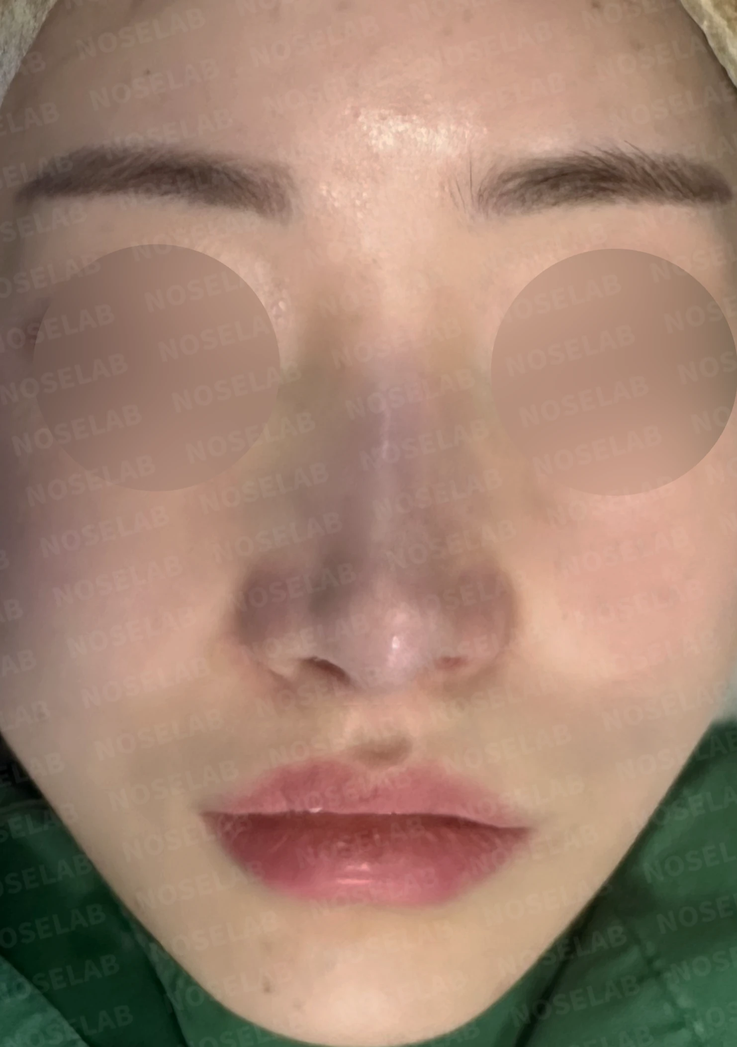 화살코와 복코가 함께 있는 코, 비중격 재건부터 시작하는 이유 — 수술 전 / 수술 직후 0일 직후 사진은 부기가 있는 상태로 최종 결과와 다를 수 있습니다.