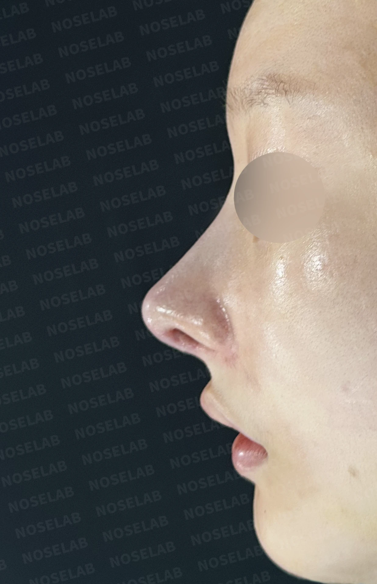 절골 부위가 과하게 깎이면 코가 왜 휘어 보이는가, 코뼈 복원과 코끝 재건 — 수술 직후 0일 정면, 비스듬한 측면, 측면 사진입니다 직후 사진은 부기가 있는 상태로 최종 결과와 다를 수 있습니다.