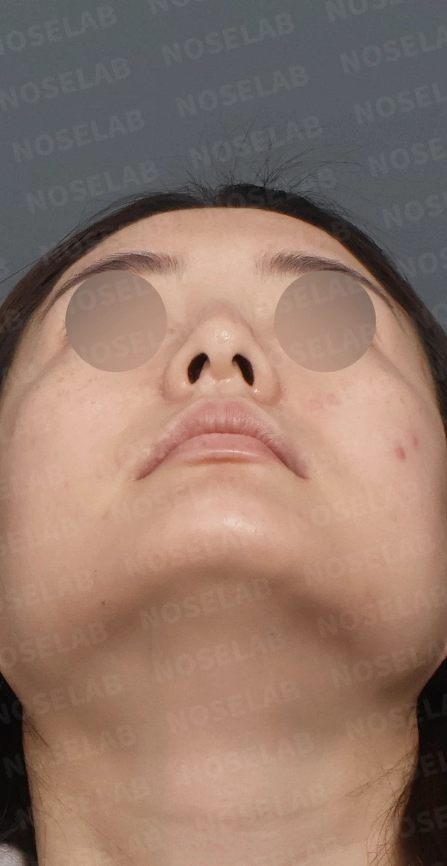 매부리코 교정, 자가늑연골로 자연스러운 코 라인 완성 — 디자인 상담 우측 측면, 비스듬한 측면, 비공 사진입니다.