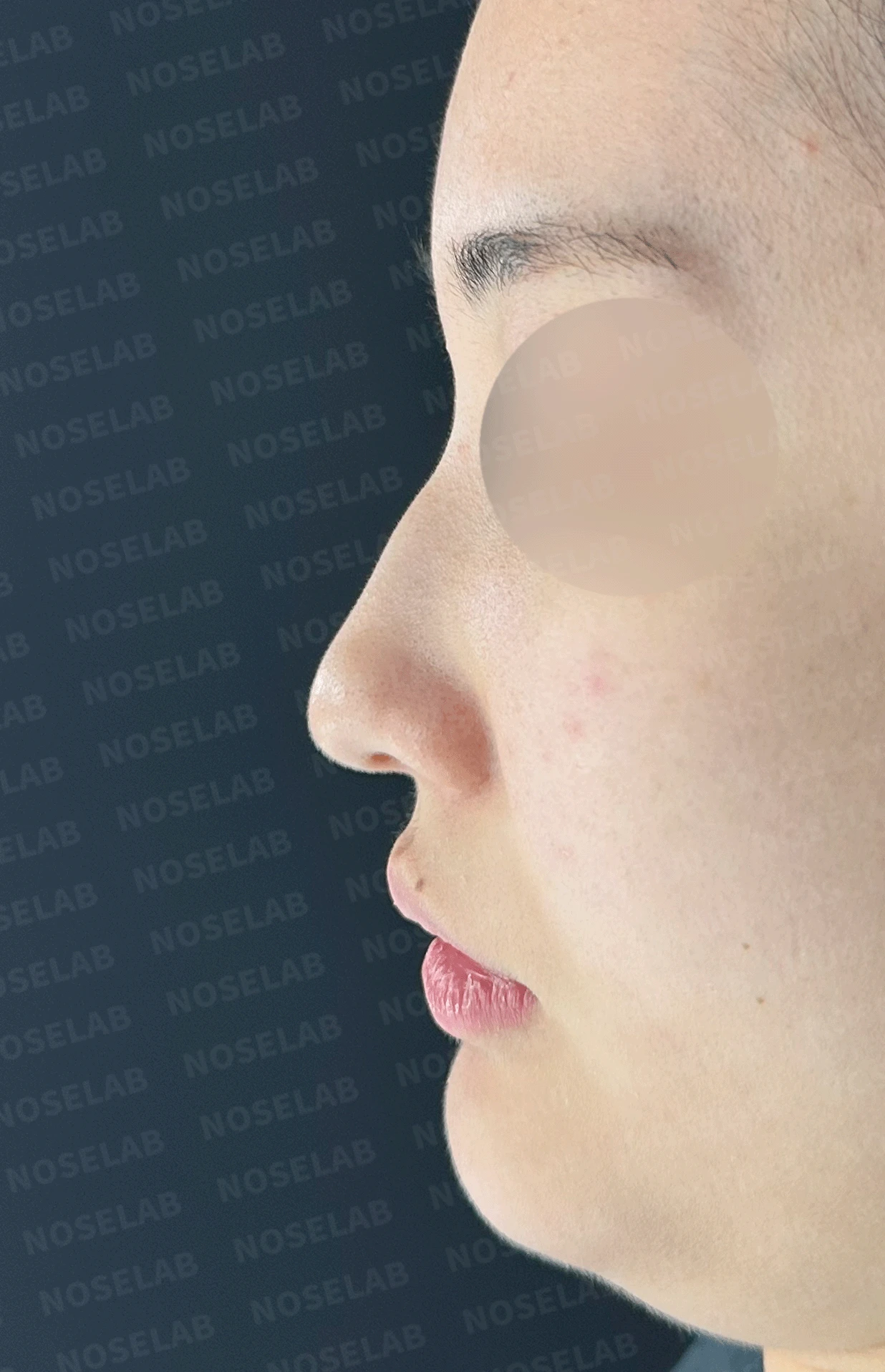 웃을 때만 화살코가 되는 이유와 코끝 연골 교정 방법 — 본문 사진 13
