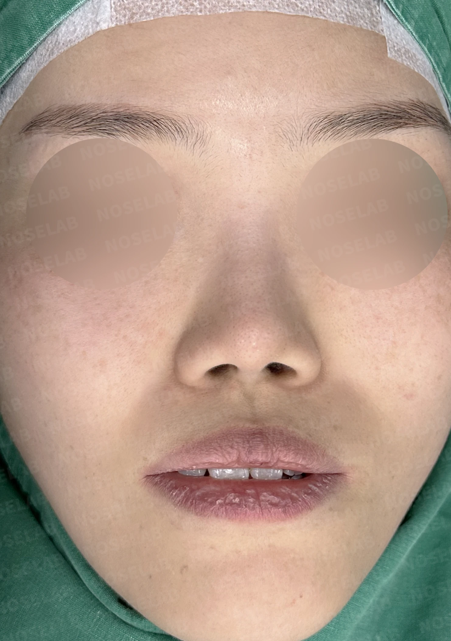 짧고 들린 코와 휜 코가 함께 생기는 이유, 비중격 연장 교정은 어떻게 하나 — 수술 전 / 수술 직후 0일 직후 사진은 부기가 있는 상태로 최종 결과와 다를 수 있습니다.
