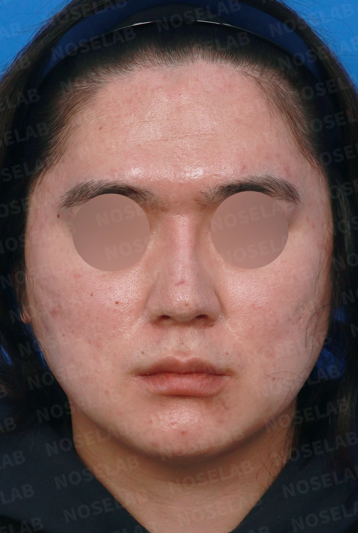 콧대를 더 높이고 싶을 때 무엇이 한계를 만드나, 3D 맞춤 보형물과 자가늑연골 코끝 지지 — 디자인 상담 정면, 좌측 측면, 비스듬한 측면 사진입니다.