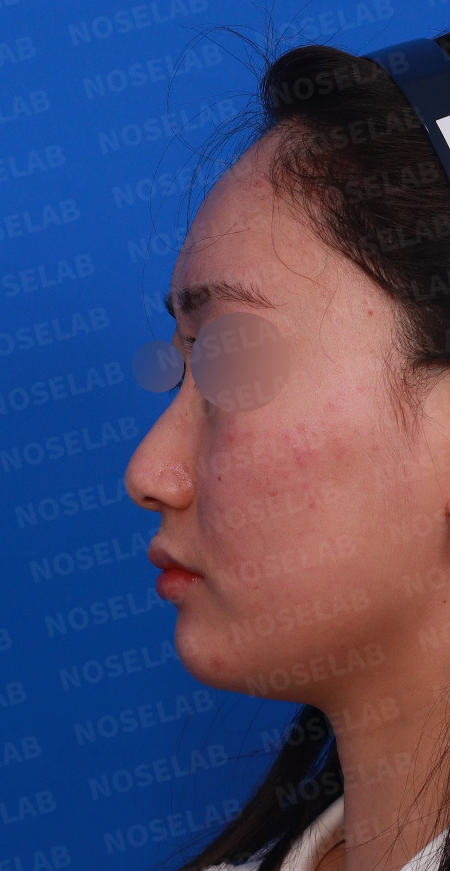 코끝이 뭉툭하게 퍼지고 코가 휘어 보이는 이유, 늑연골 재건은 어떻게 하나 — 디자인 상담 정면 , 좌측 비스듬한 측면 , 측면 사진입니다.