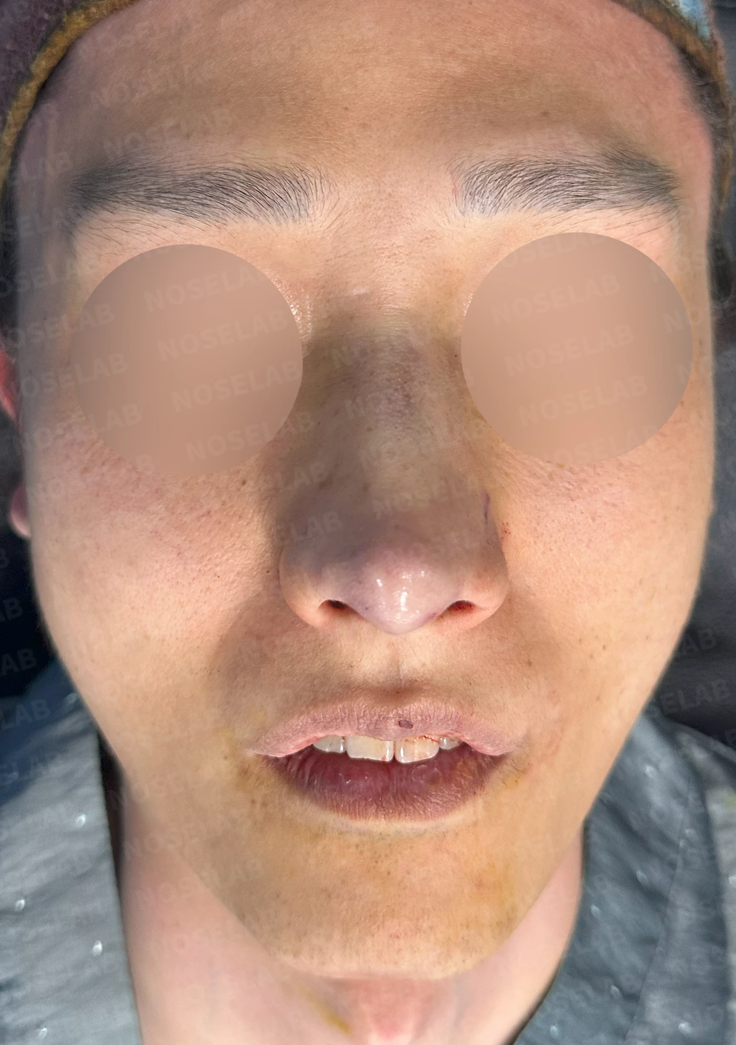 안면 비대칭이 있는 코에 맞춤형 보형물을 쓰는 이유와 매부리 교정 방법 — 본문 사진 9