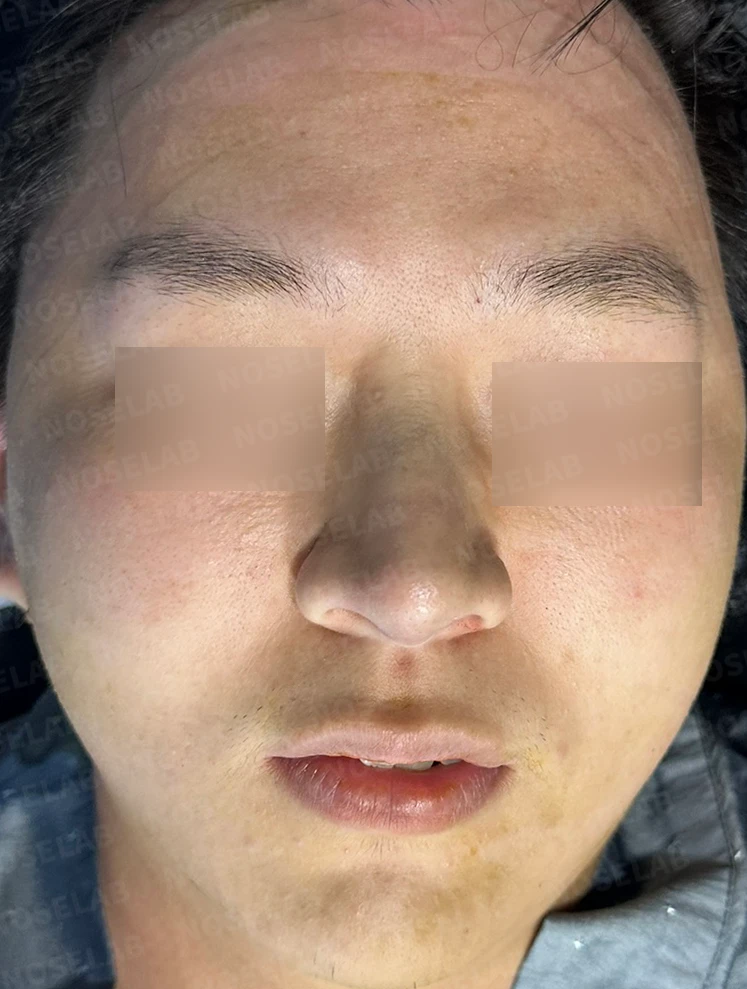 코막힘과 복코를 함께 살펴보는 교정 방법 — 수술 전 / 수술 직후 0일 직후 사진은 부기가 있는 상태로 최종 결과와 다를 수 있습니다.