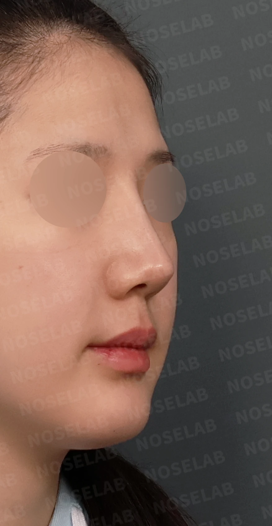 코재수술, 휘어진 코뼈와 매부리코를 외측 절골술과 자가늑연골로 자연스럽게 교정 — 디자인 상담 우측 측면, 비스듬한 측면, 비공 사진입니다.